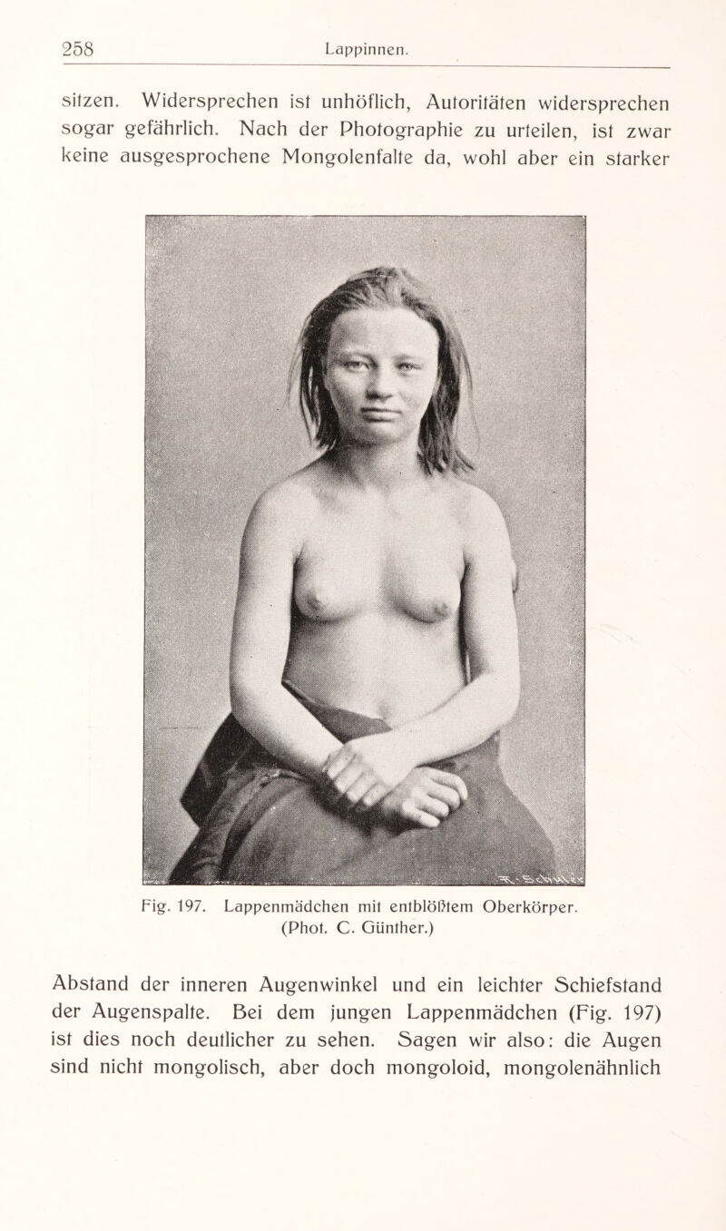 sitzen. Widersprechen ist unhöflich, Autoritäten widersprechen sogar gefährlich. Nach der Photographie zu urteilen, ist zwar keine ausgesprochene Mongolenfalte da, wohl aber ein starker Fig. 197. Lappenmädchen mit entblößtem Oberkörper. (Phot. C. Günther.) Abstand der inneren Augenwinkel und ein leichter Schiefstand der Augenspalte. Bei dem jungen Lappenmädchen (Fig. 197) ist dies noch deutlicher zu sehen. Sagen wir also: die Augen sind nicht mongolisch, aber doch mongoloid, mongolenähnlich