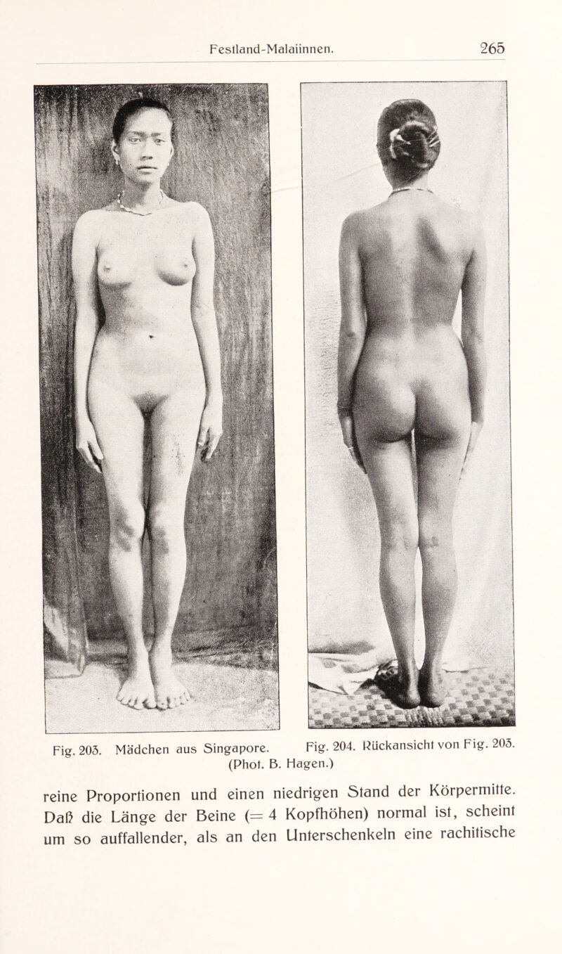 Fig. 205. Mädchen aus Singapore. Fig. 204. Rückansicht von Fig. 205. (Phot. B. Hagen.) reine Proportionen und einen niedrigen Stand der Körpermitte. Daß die Länge der Beine (= 4 Kopfhöhen) normal ist, scheint um so auffallender, als an den Unterschenkeln eine rachitische