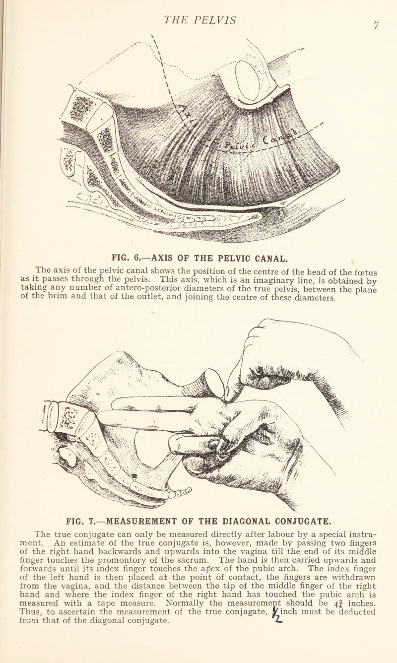 \ FIG. 6.—AXIS OF THE PELVIC CANAL. The axis of the pelvic canal shows the position of the centre of the head of the foetus as it passes through the pelvis. This axis, which is an imaginary line, is obtained by taking any number of antero-posterior diameters of the true pelvis, between the plane of the brim and that of the outlet, and joining the centre of these diameters, FIG. 7.—MEASUREMENT OF THE DIAGONAL CONJUGATE. The true conjugate can only be measured directly after labour by a special instru¬ ment. An estimate of the true conjugate is, however, made by passing two fingers of the right hand backwards and upwards into the vagina till the end of its middle finger touches the promontory of the sacrum. The hand is then carried upwards and forwards until its index finger touches the apex of the pubic arch. The index finger of the left hand is then placed at the point of contact, the fingers are withdrawn from the vagina, and the distance between the tip of the middle finger of the right hand and where the index finger of the right hand has touched the pubic arch is measured with a tape measure. Normally the measurement should be 4f inches. Thus, to ascertain the measurement of the true conjugate, Vinch must be deducted from that of the diagonal conjugate. 2.