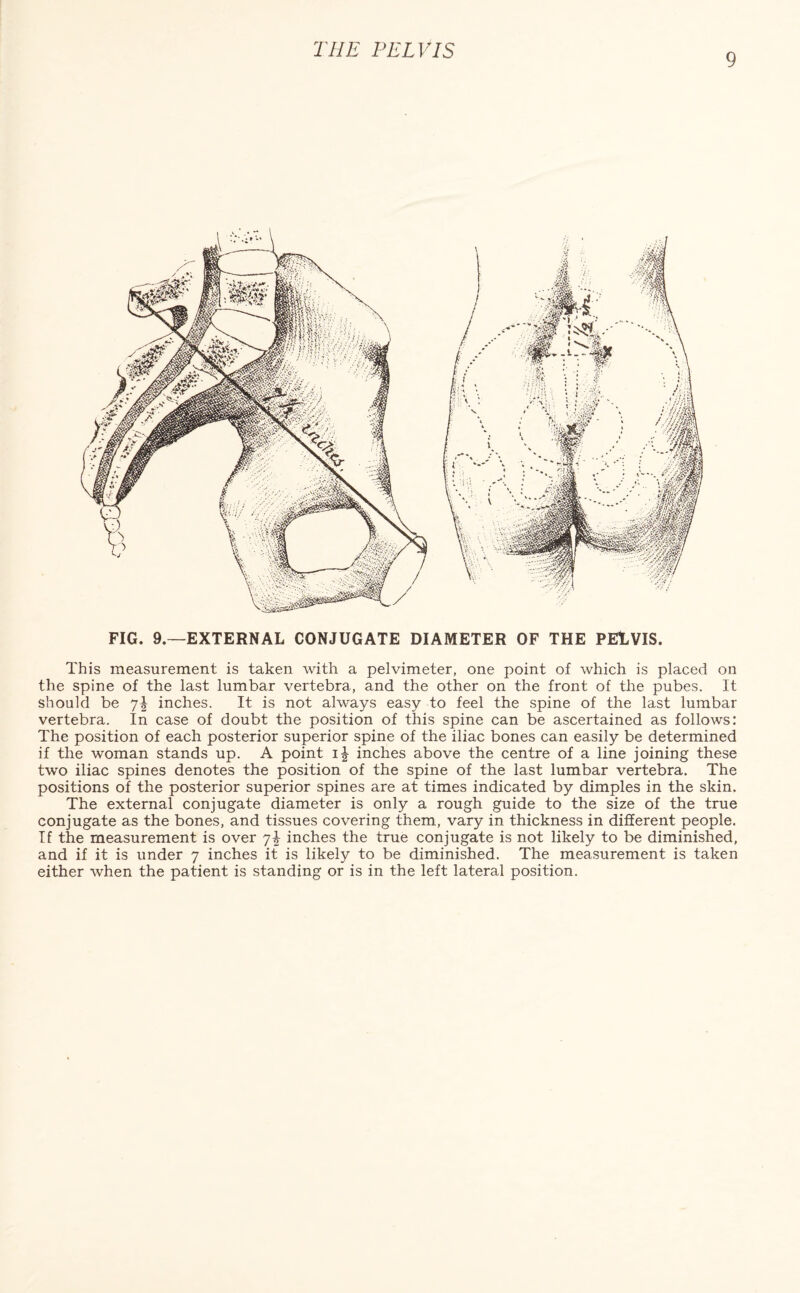 9 FIG. 9.—EXTERNAL CONJUGATE DIAMETER OF THE PELVIS. This measurement is taken with a pelvimeter, one point of which is placed on the spine of the last lumbar vertebra, and the other on the front of the pubes. It should be inches. It is not always easy to feel the spine of the last lumbar vertebra. In case of doubt the position of this spine can be ascertained as follows: The position of each posterior superior spine of the iliac bones can easily be determined if the woman stands up. A point inches above the centre of a line joining these two iliac spines denotes the position of the spine of the last lumbar vertebra. The positions of the posterior superior spines are at times indicated by dimples in the skin. The external conjugate diameter is only a rough guide to the size of the true conjugate as the bones, and tissues covering them, vary in thickness in different people. If the measurement is over jb inches the true conjugate is not likely to be diminished, and if it is under 7 inches it is likely to be diminished. The measurement is taken either when the patient is standing or is in the left lateral position.