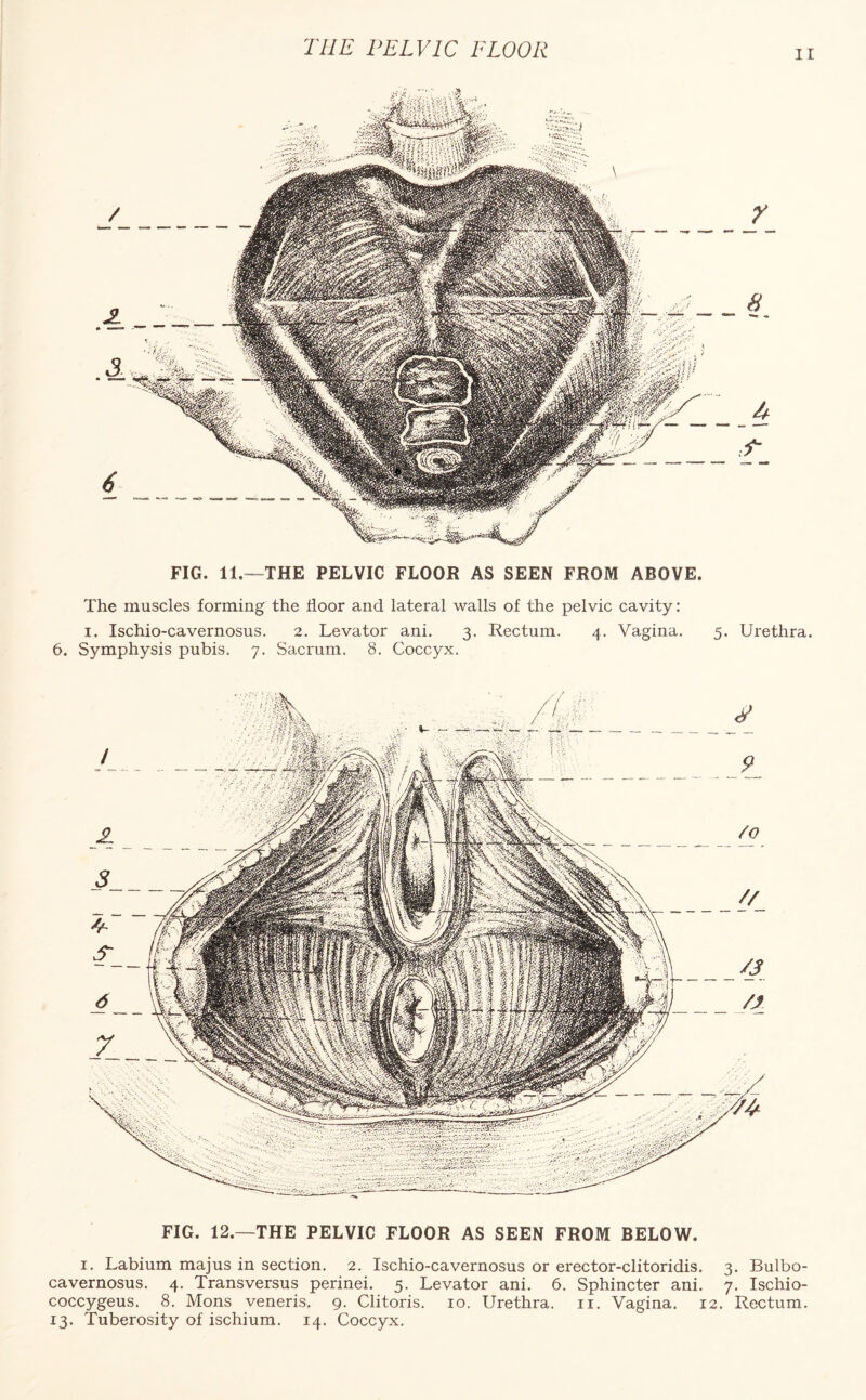 THE PELVIC FLOOR ii FIG. 11.—THE PELVIC FLOOR AS SEEN FROM ABOVE. The muscles forming the floor and lateral walls of the pelvic cavity: i. Ischio-cavernosus. 2. Levator ani. 3. Rectum. 4. Vagina. 5. Urethra. 6. Symphysis pubis. 7. Sacrum. 8. Coccyx. FIG. 12.—THE PELVIC FLOOR AS SEEN FROM BELOW. 1. Labium majus in section. 2. Ischio-cavernosus or erector-clitoridis. 3. Bulbo- cavernosus. 4. Transversus perinei. 5. Levator ani. 6. Sphincter ani. 7. Ischio- coccygeus. 8. Mons veneris. 9. Clitoris. 10. Urethra. 11. Vagina. 12. Rectum. 13. Tuberosity of ischium. 14. Coccyx.