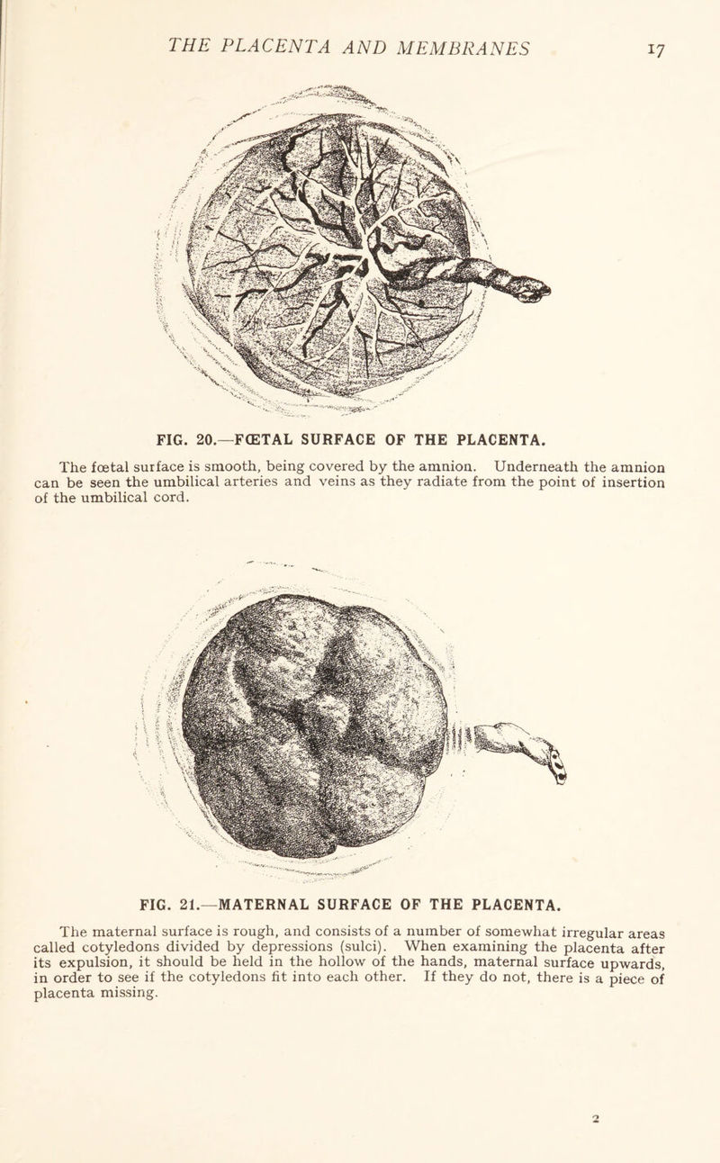 *7 FIG. 20.—FCETAL SURFACE OF THE PLACENTA. The foetal surface is smooth, being covered by the amnion. Underneath the amnion can be seen the umbilical arteries and veins as they radiate from the point of insertion of the umbilical cord. FIG. 21.—MATERNAL SURFACE OF THE PLACENTA. The maternal surface is rough, and consists of a number of somewhat irregular areas called cotyledons divided by depressions (sulci). When examining the placenta after its expulsion, it should be held in the hollow of the hands, maternal surface upwards, in order to see if the cotyledons fit into each other. If they do not, there is a piece of placenta missing. 2