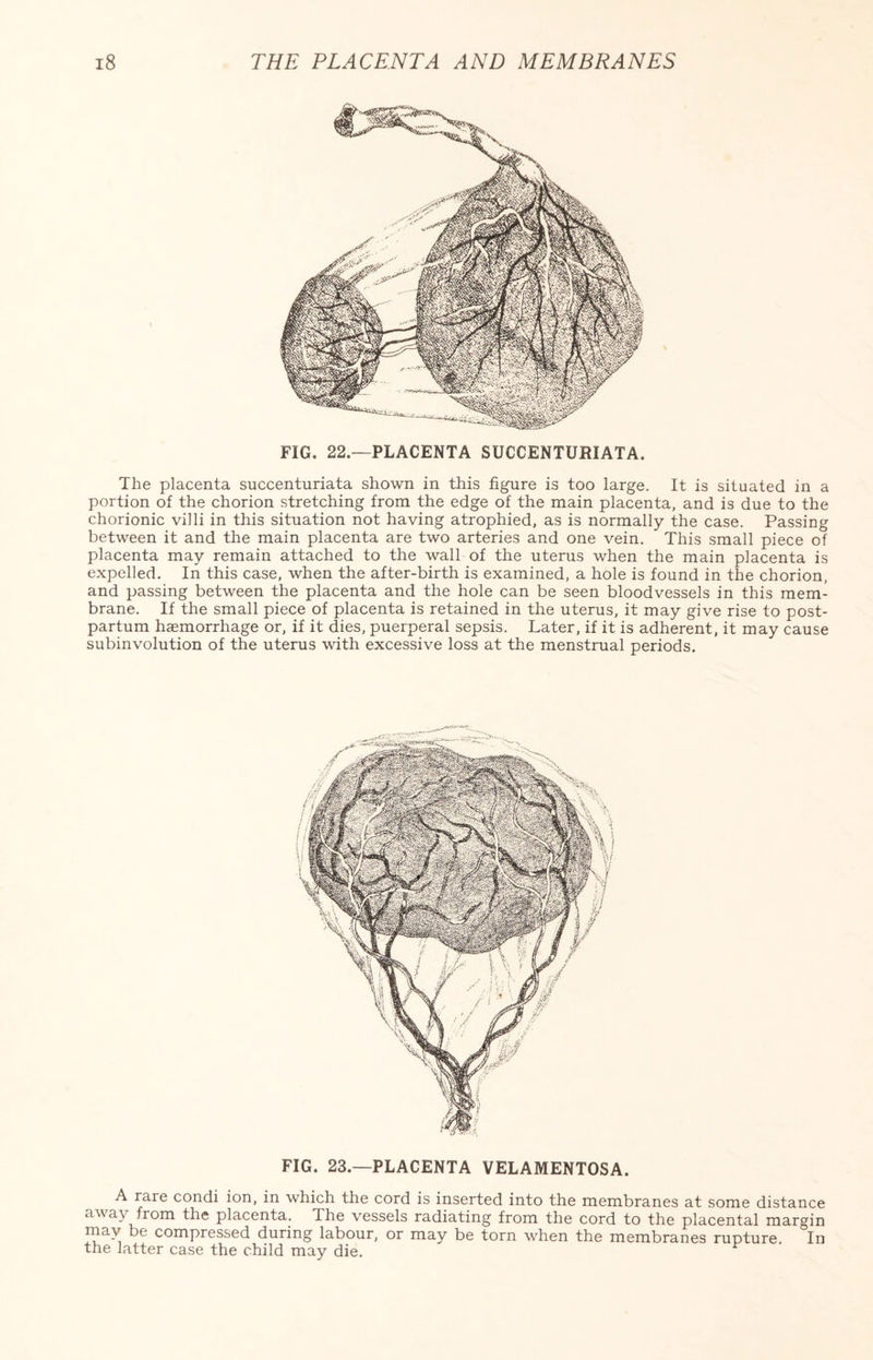 FIG. 22.—PLACENTA SUCCENTURIATA. The placenta succenturiata shown in this figure is too large. It is situated in a portion of the chorion stretching from the edge of the main placenta, and is due to the chorionic villi in this situation not having atrophied, as is normally the case. Passing between it and the main placenta are two arteries and one vein. This small piece of placenta may remain attached to the wall of the uterus when the main placenta is expelled. In this case, when the after-birth is examined, a hole is found in the chorion, and passing between the placenta and the hole can be seen bloodvessels in this mem¬ brane. If the small piece of placenta is retained in the uterus, it may give rise to post¬ partum haemorrhage or, if it dies, puerperal sepsis. Later, if it is adherent, it may cause subinvolution of the uterus with excessive loss at the menstrual periods. FIG. 23.—PLACENTA VELAMENTOSA. A rare condi ion, in which the cord is inserted into the membranes at some distance aw ay from the placenta. The vessels radiating from the cord to the placental margin mav be compressed during labour, or may be torn when the membranes rupture In the latter case the child may die.