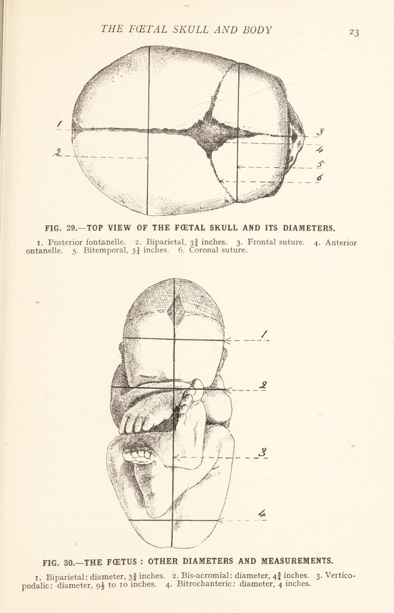 23 J 4 S' d FIG. 29.— TOP VIEW OF THE FCETAL SKULL AND ITS DIAMETERS, i. Posterior fontanelle. 2. Biparietal, 3| inches. 3. Frontal suture. 4. Anterior ontanelle. 5. Bitemporal, 3J inches. 6. Coronal suture. FIG. 30.—THE FCETUS : OTHER DIAMETERS AND MEASUREMENTS. 1. Biparietal: diameter, 3I inches. 2. Bis-acromial: diameter, 4! inches. 3. Vertico- podalic: diameter, 9! to 10 inches. 4. Bitrochanteric: diameter, 4 inches.