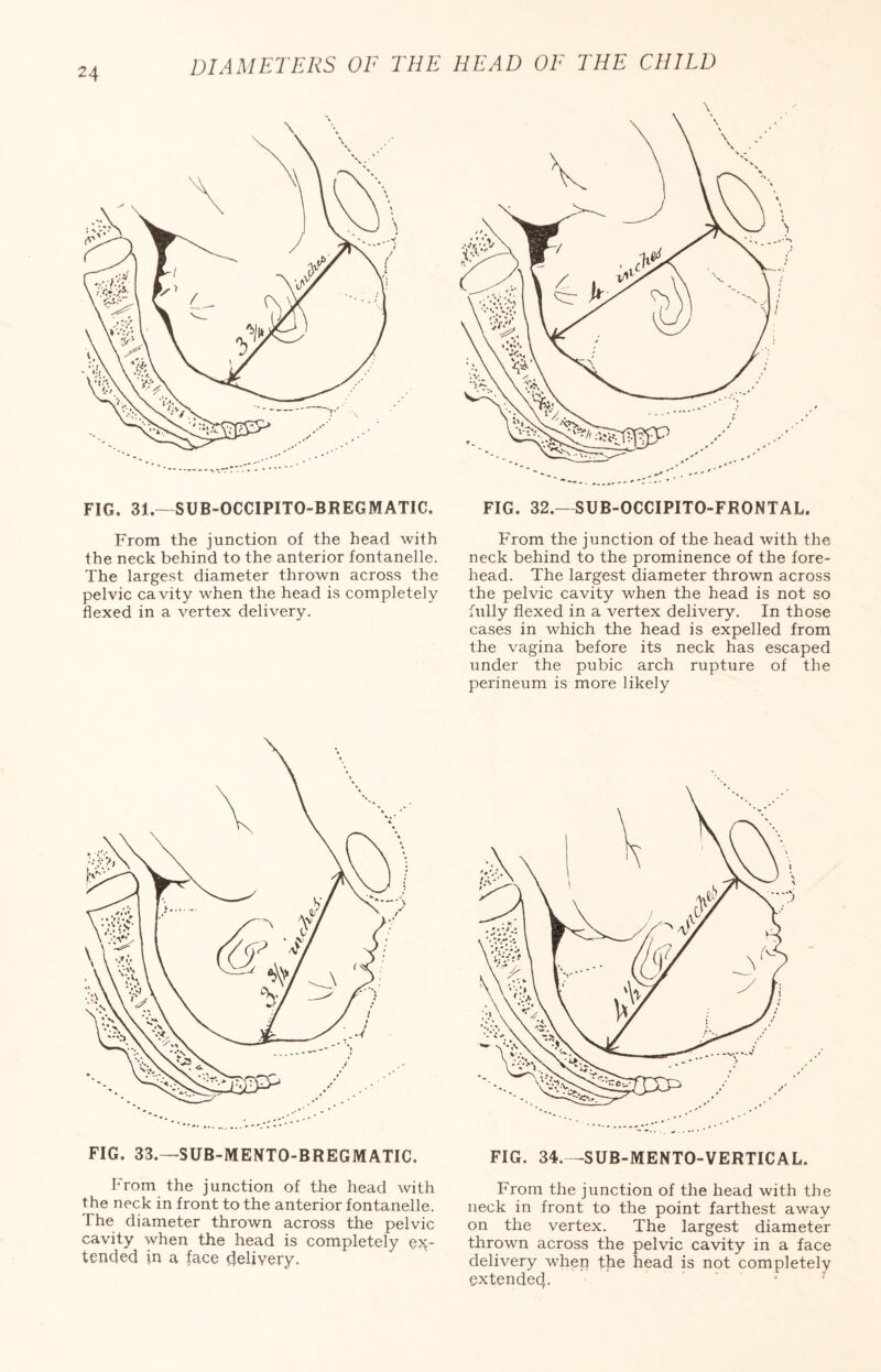 FIG. 31.—SUB-OCCIPITO-BREGMATIC. From the junction of the head with the neck behind to the anterior fontanelle. The largest diameter thrown across the pelvic cavity when the head is completely flexed in a vertex delivery. FIG. 33.—SUB-MENTO-BREGMATIC. From the junction of the head with the neck in front to the anterior fontanelle. The diameter thrown across the pelvic cavity when the head is completely ex¬ tended in a face delivery. FIG. 32.—SUB-OCCIPITO-FRONTAL. From the junction of the head with the neck behind to the prominence of the fore¬ head. The largest diameter thrown across the pelvic cavity when the head is not so fully flexed in a vertex delivery. In those cases in which the head is expelled from the vagina before its neck has escaped under the pubic arch rupture of the perineum is more likely FIG. 34.—SUB-MENTO-VERTICAL. From the junction of the head with the neck in front to the point farthest away on the vertex. The largest diameter thrown across the pelvic cavity in a face delivery when the head is not completely extended.