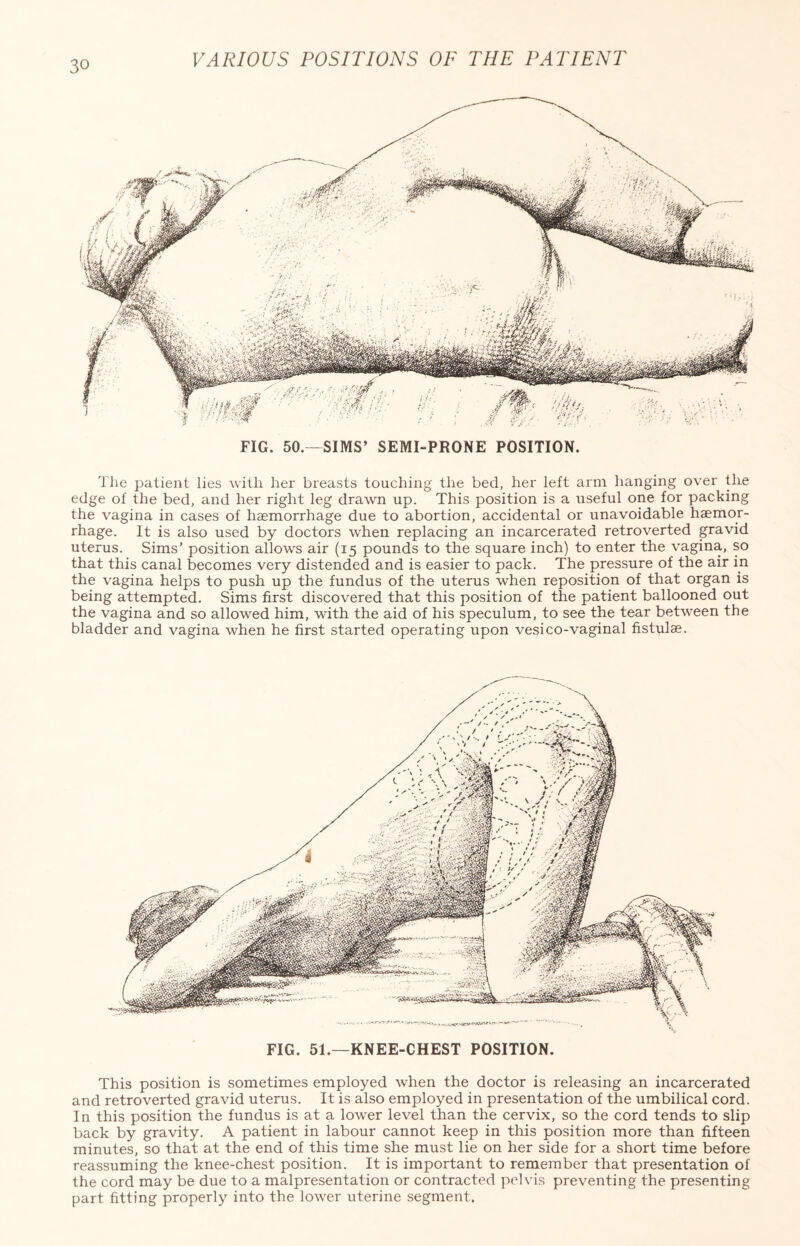 FIG. 50.—SIMS’ SEMI-PRONE POSITION. The patient lies with her breasts touching the bed, her left arm hanging over tlie edge of the bed, and her right leg drawn up. This position is a useful one for packing the vagina in cases of haemorrhage due to abortion, accidental or unavoidable haemor¬ rhage. It is also used by doctors when replacing an incarcerated retroverted gravid uterus. Sims' position allows air (15 pounds to the square inch) to enter the vagina, so that this canal becomes very distended and is easier to pack. The pressure of the air in the vagina helps to push up the fundus of the uterus when reposition of that organ is being attempted. Sims first discovered that this position of the patient ballooned out the vagina and so allowed him, with the aid of his speculum, to see the tear between the bladder and vagina when he first started operating upon vesico-vaginal fistulae. FIG. 51.—KNEE-CHEST POSITION. This position is sometimes employed when the doctor is releasing an incarcerated and retroverted gravid uterus. It is also employed in presentation of the umbilical cord. In this position the fundus is at a lower level than the cervix, so the cord tends to slip back by gravity. A patient in labour cannot keep in this position more than fifteen minutes, so that at the end of this time she must lie on her side for a short time before reassuming the knee-chest position. It is important to remember that presentation of the cord may be due to a malpresentation or contracted pelvis preventing the presenting part fitting properly into the lower uterine segment.