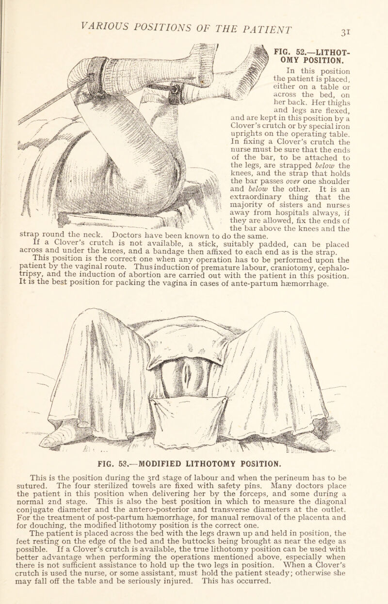 In this position the patient is placed, either on a table or across the bed, on her back. Her thighs and legs are flexed, and are kept in this position by a Clover’s crutch or by special iron uprights on the operating table. In fixing a Clover’s crutch the nurse must be sure that the ends of the bar, to be attached to the legs, are strapped below the knees, and the strap that holds the bar passes over one shoulder and below the other. It is an extraordinary thing that the \ majority of sisters and nurses away from hospitals always, if they are allowed, fix the ends of the bar above the knees and the strap round the neck. Doctors have been known to do the same. If a Clover’s crutch is not available, a stick, suitably padded, can be placed across and under the knees, and a bandage then affixed to each end as is the strap. This position is the correct one when any operation has to be performed upon the patient by the vaginal route. Thus induction of premature labour, craniotomy, cephalo- tripsy, and the induction of abortion are carried out with the patient in this position. It is the best position for packing the vagina in cases of ante-partum haemorrhage. FIG. 52.—LITHOT¬ OMY POSITION. FIG. 53.—MODIFIED LITHOTOMY POSITION. This is the position during the 3rd stage of labour and when the perineum has to be sutured. The four sterilized towels are fixed with safety pins. Many doctors place the patient in this position when delivering her by the forceps, and some during a normal 2nd stage. This is also the best position in which to measure the diagonal conjugate diameter and the antero-posterior and transverse diameters at the outlet. For the treatment of post-partum haemorrhage, for manual removal of the placenta and for douching, the modified lithotomy position is the correct one. The patient is placed across the bed with the legs drawn up and held in position, the feet resting on the edge of the bed and the buttocks being brought as near the edge as possible. If a Clover’s crutch is available, the true lithotomy position can be used with better advantage when performing the operations mentioned above, especially when there is not sufficient assistance to hold up the two legs in position. When a Clover’s crutch is used the nurse, or some assistant, must hold the patient steady; otherwise she may fall off the table and be seriously injured. This has occurred.