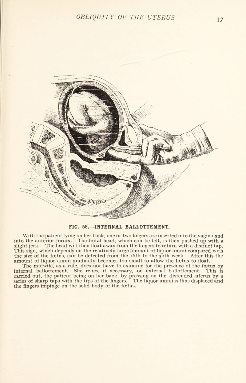 FIG. 58.—INTERNAL BALLOTTEMENT. With the patient lying on her back, one or two fingers are inserted into the vagina and into the anterior fornix. The foetal head, which can be felt, is then pushed up with a slight jerk. The head will then float away from the fingers to return with a distinct tap. This sign, which depends on the relatively large amount of liquor amnii compared with the size of the foetus, can be detected from the 16th to the 30th week. After this the amount of liquor amnii gradually becomes too small to allow the foetus to float. The midwife, as a rule, does not have to examine for the presence of the foetus by internal ballottement. She relies, if necessary, on external ballottement. This is carried out, the patient being on her back, by pressing on the distended uterus by a series of sharp taps with the tips of the fingers. The liquor amnii is thus displaced and the fingers impinge on the solid body of the foetus.