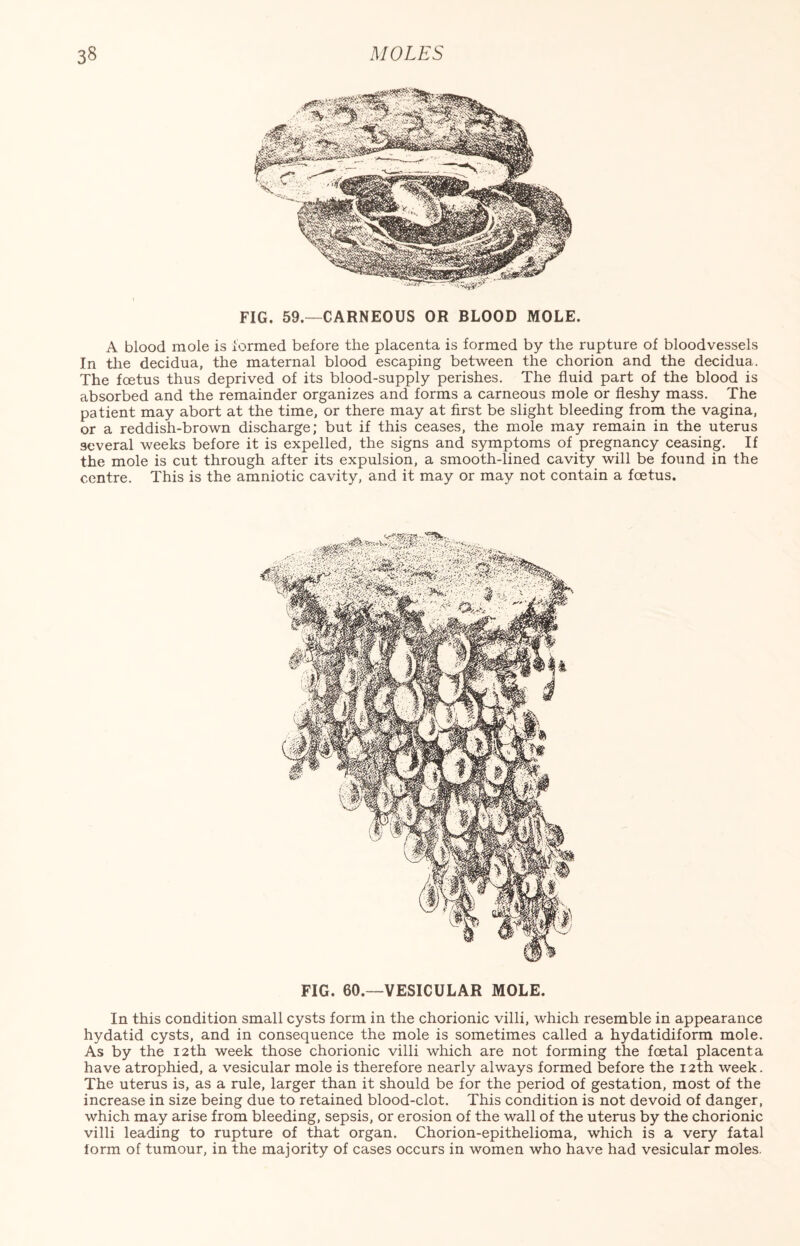 3§ MOLES FIG. 59.—CARNEOUS OR BLOOD MOLE. A blood mole is formed before the placenta is formed by the rupture of bloodvessels In the decidua, the maternal blood escaping between the chorion and the decidua. The foetus thus deprived of its blood-supply perishes. The fluid part of the blood is absorbed and the remainder organizes and forms a carneous mole or fleshy mass. The patient may abort at the time, or there may at first be slight bleeding from the vagina, or a reddish-brown discharge; but if this ceases, the mole may remain in the uterus several weeks before it is expelled, the signs and symptoms of pregnancy ceasing. If the mole is cut through after its expulsion, a smooth-lined cavity will be found in the centre. This is the amniotic cavity, and it may or may not contain a foetus. FIG. 60.—VESICULAR MOLE. In this condition small cysts form in the chorionic villi, which resemble in appearance hydatid cysts, and in consequence the mole is sometimes called a hydatidiform mole. As by the 12th week those chorionic villi which are not forming the foetal placenta have atrophied, a vesicular mole is therefore nearly always formed before the 12th week. The uterus is, as a rule, larger than it should be for the period of gestation, most of the increase in size being due to retained blood-clot. This condition is not devoid of danger, which may arise from bleeding, sepsis, or erosion of the wall of the uterus by the chorionic villi leading to rupture of that organ. Chorion-epithelioma, which is a very fatal form of tumour, in the majority of cases occurs in women who have had vesicular moles.