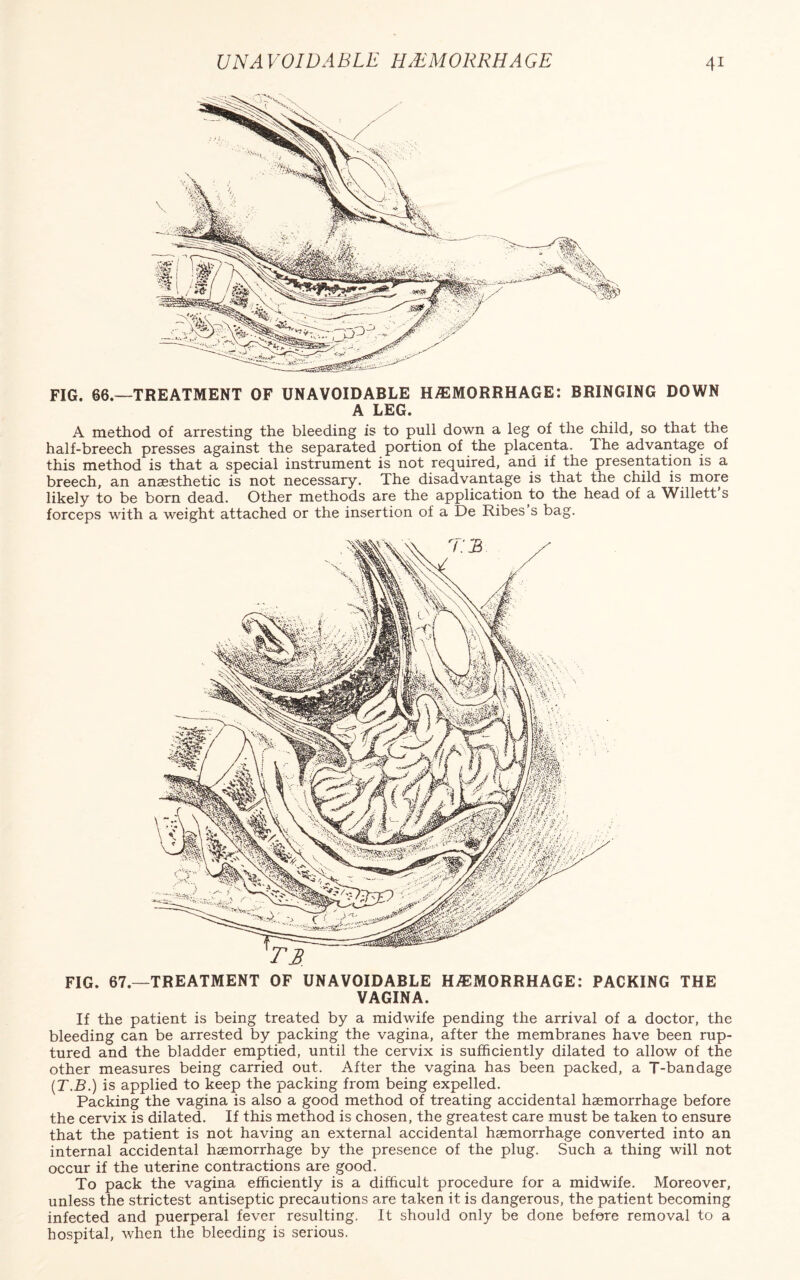 FIG. 66.—TREATMENT OF UNAVOIDABLE HHEMORRHAGE: BRINGING DOWN A LEG. A method of arresting the bleeding is to pull down a leg of the child, so that the half-breech presses against the separated portion of the placenta. Ihe advantage of this method is that a special instrument is not required, and if the presentation is a breech, an anaesthetic is not necessary. The disadvantage is that the child is more likely to be born dead. Other methods are the application to the head of a Willett s forceps with a weight attached or the insertion of a De Ribes s bag. FIG. 67—TREATMENT OF UNAVOIDABLE HAEMORRHAGE: PACKING THE VAGINA. If the patient is being treated by a midwife pending the arrival of a doctor, the bleeding can be arrested by packing the vagina, after the membranes have been rup¬ tured and the bladder emptied, until the cervix is sufficiently dilated to allow of the other measures being carried out. After the vagina has been packed, a T-bandage (T.B.) is applied to keep the packing from being expelled. Packing the vagina is also a good method of treating accidental haemorrhage before the cervix is dilated. If this method is chosen, the greatest care must be taken to ensure that the patient is not having an external accidental haemorrhage converted into an internal accidental haemorrhage by the presence of the plug. Such a thing will not occur if the uterine contractions are good. To pack the vagina efficiently is a difficult procedure for a midwife. Moreover, unless the strictest antiseptic precautions are taken it is dangerous, the patient becoming infected and puerperal fever resulting. It should only be done before removal to a hospital, when the bleeding is serious.