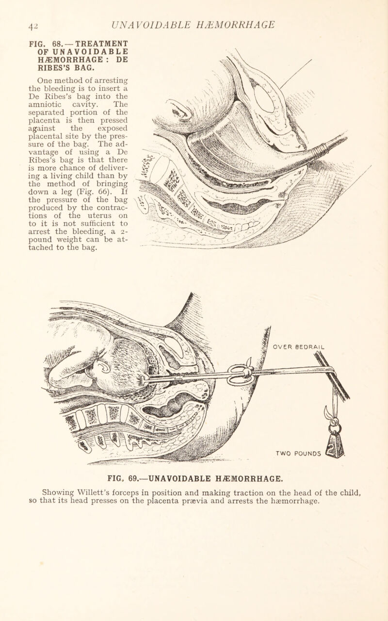 FIG. 68. —TREATMENT OF UNAVOIDABLE HAEMORRHAGE : DE RIBES’S BAG. One method of arresting the bleeding is to insert a De Ribes’s bag into the amniotic cavity. The separated portion of the placenta is then pressed against the exposed placental site by the pres¬ sure of the bag. The ad¬ vantage of using a De Ribes’s bag is that there is more chance of deliver¬ ing a living child than by the method of bringing down a leg (Fig. 66). If the pressure of the bag produced by the contrac¬ tions of the uterus on to it is not sufficient to arrest the bleeding, a 2- pound weight can be at¬ tached to the bag. FIG* 69.—UNAVOIDABLE HAEMORRHAGE. Showing Willett’s forceps in position and making traction on the head of the child, so that its head presses on the placenta praevia and arrests the haemorrhage.