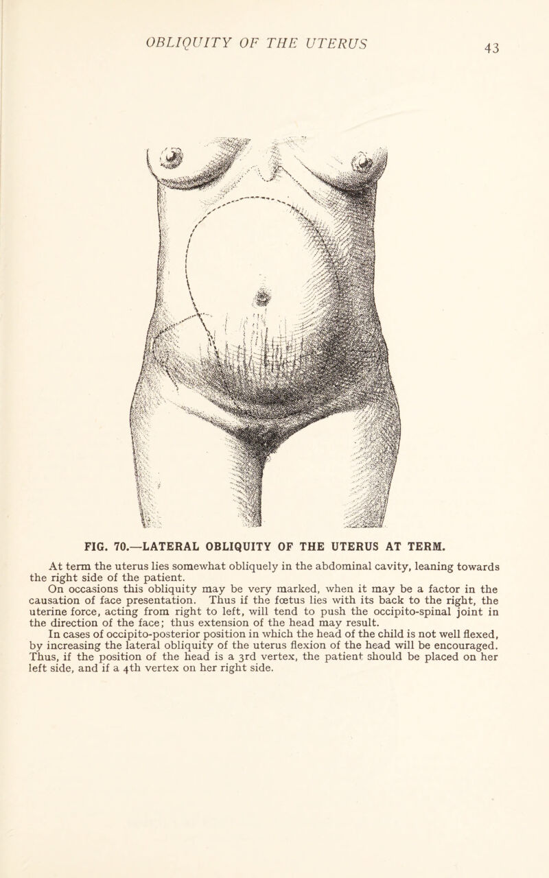 FIG. 70.—LATERAL OBLIQUITY OF THE UTERUS AT TERM. At term the uterus lies somewhat obliquely in the abdominal cavity, leaning towards the right side of the patient. On occasions this obliquity may be very marked, when it may be a factor in the causation of face presentation. Thus if the foetus lies with its back to the right, the uterine force, acting from right to left, will tend to push the occipito-spinal joint in the direction of the face; thus extension of the head may result. In cases of occipito-posterior position in which the head of the child is not well flexed, by increasing the lateral obliquity of the uterus flexion of the head will be encouraged. Thus, if the position of the head is a 3rd vertex, the patient should be placed on her left side, and if a 4th vertex on her right side.