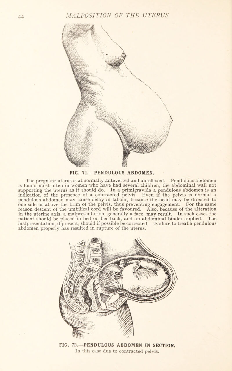 The pregnant uterus is abnormally anteverted and anteflexed. Pendulous abdomen is found most often in women who have had several children, the abdominal wall not supporting the uterus as it should do. In a primigravida a pendulous abdomen is an indication of the presence of a contracted pelvis. Even if the pelvis is normal a pendulous abdomen may cause delay in labour, because the head may be directed to one side or above the brim of the pelvis, thus preventing engagement. For the same reason descent of the umbilical cord will be favoured. Also, because of the alteration in the uterine axis, a malpresentation, generally a face, may result. In such cases the patient should be placed in bed on her back, and an abdominal binder applied. The malpresentation, if present, should if possible be corrected. Failure to treat a pendulous abdomen properly has resulted in rupture of the uterus. FIG. 72.—PENDULOUS ABDOMEN IN SECTION. In this case due to contracted pelvis.