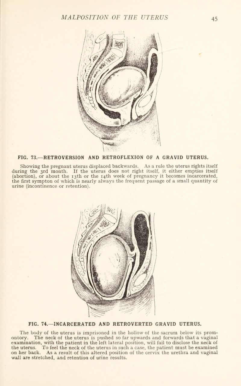 FIG. 73.—RETROVERSION AND RETROFLEXION OF A GRAVID UTERUS. Showing the pregnant uterus displaced backwards. As a rule the uterus rights itself during the 3rd month. If the uterus does not right itself, it either empties itself (abortion), or about the 13th or the 14th week of pregnancy it becomes incarcerated, the first sympton of which is nearly always the frequent passage of a small quantity of urine (incontinence or retention). FIG. 74.—INCARCERATED AND RETROVERTED GRAVID UTERUS. The body of the uterus is imprisoned in the hollow of the sacrum below its prom¬ ontory. The neck of the uterus is pushed so far upwards and forwards that a vaginal examination, with the patient in the left lateral position, will fail to disclose the neck of the uterus. To feel the neck of the uterus in such a case, the patient must be examined on her back. As a result of this altered position of the cervix the urethra and vaginal wall are stretched, and retention of urine results.