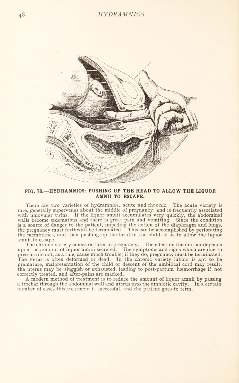 FIG. 78.—HYDRAMNIOS: PUSHING UP THE HEAD TO ALLOW THE LIQUOR AMNII TO ESCAPE. There are two varieties of hydramnios, acute and chronic. The acute variety is rare, generally supervenes about the middle of pregnancy, and is frequently associated with uniovular twins. If the liquor amnii accumulates very quickly, the abdominal walls become oedematous and there is great pain and vomiting. Since the condition is a source of danger to the patient, impeding the action of the diaphragm and lungs, the pregnancy must forthwith be terminated. This can be accomplished by perforating the membranes, and then pushing up the head of the child so as to allow the liquor amnii to escape. The chronic variety comes on later in pregnancy. The effect on the mother depends upon the amount of liquor amnii secreted. The symptoms and signs which are due to pressure do not, as a rule, cause much trouble; if they do, pregnancy must be terminated. The foetus is often deformed or dead. In the chronic variety labour is apt to be premature, malpresentation of the child or descent of the umbilical cord may result, the uterus may be sluggish or exhausted, leading to post-partum haemorrhage if not correctly treated, and after-pains are marked. A modern method of treatment is to reduce the amount of liquor amnii by passing a trochar through the abdominal wall and uterus into the amniotic cavity. In a certain number of cases this treatment is successful, and the patient goes to term.