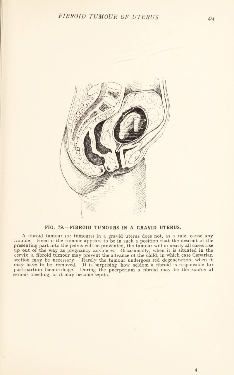 FIBROID TUMOUR OF UTERUS FIG. 79.—FIBROID TUMOURS IN A GRAVID UTERUS. A fibroid tumour (or tumours) in a gravid uterus does not, as a rule, cause any trouble. Even if the tumour appears to be in such a position that the descent of the presenting part into the pelvis will be prevented, the tumour will in nearly all cases rise up out of the way as pregnancy advances. Occasionally, when it is situated in the cervix, a fibroid tumour may prevent the advance of the child, in which case Caesarian section may be necessary. Rarely the tumour undergoes red degeneration, when it may have to be removed. It is surprising how seldom a fibroid is responsible for post-partum haemorrhage. During the puerperium a fibroid may be the source of serious bleeding, or it may become septic. 4