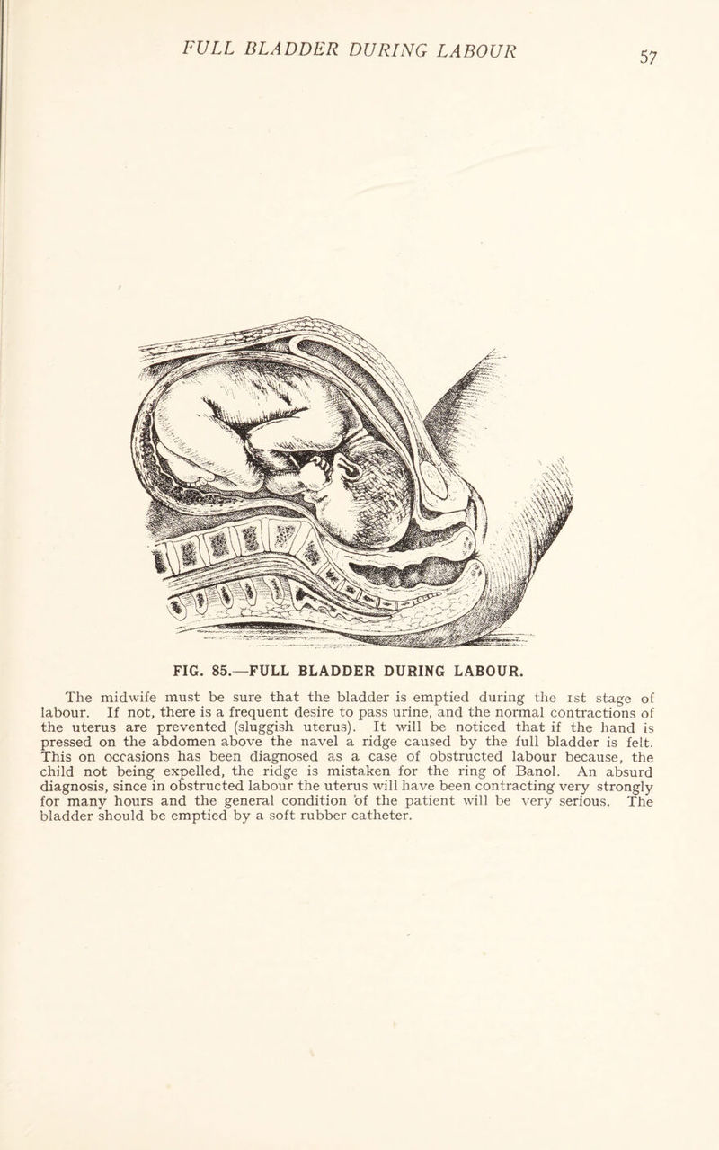 FULL BLADDER DURING LABOUR 57 FIG. 85.—FULL BLADDER DURING LABOUR. The midwife must be sure that the bladder is emptied during the ist stage of labour. If not, there is a frequent desire to pass urine, and the normal contractions of the uterus are prevented (sluggish uterus). It will be noticed that if the hand is pressed on the abdomen above the navel a ridge caused by the full bladder is felt. This on occasions has been diagnosed as a case of obstructed labour because, the child not being expelled, the ridge is mistaken for the ring of Banol. An absurd diagnosis, since in obstructed labour the uterus will have been contracting very strongly for many hours and the general condition of the patient will be very serious. The bladder should be emptied by a soft rubber catheter.