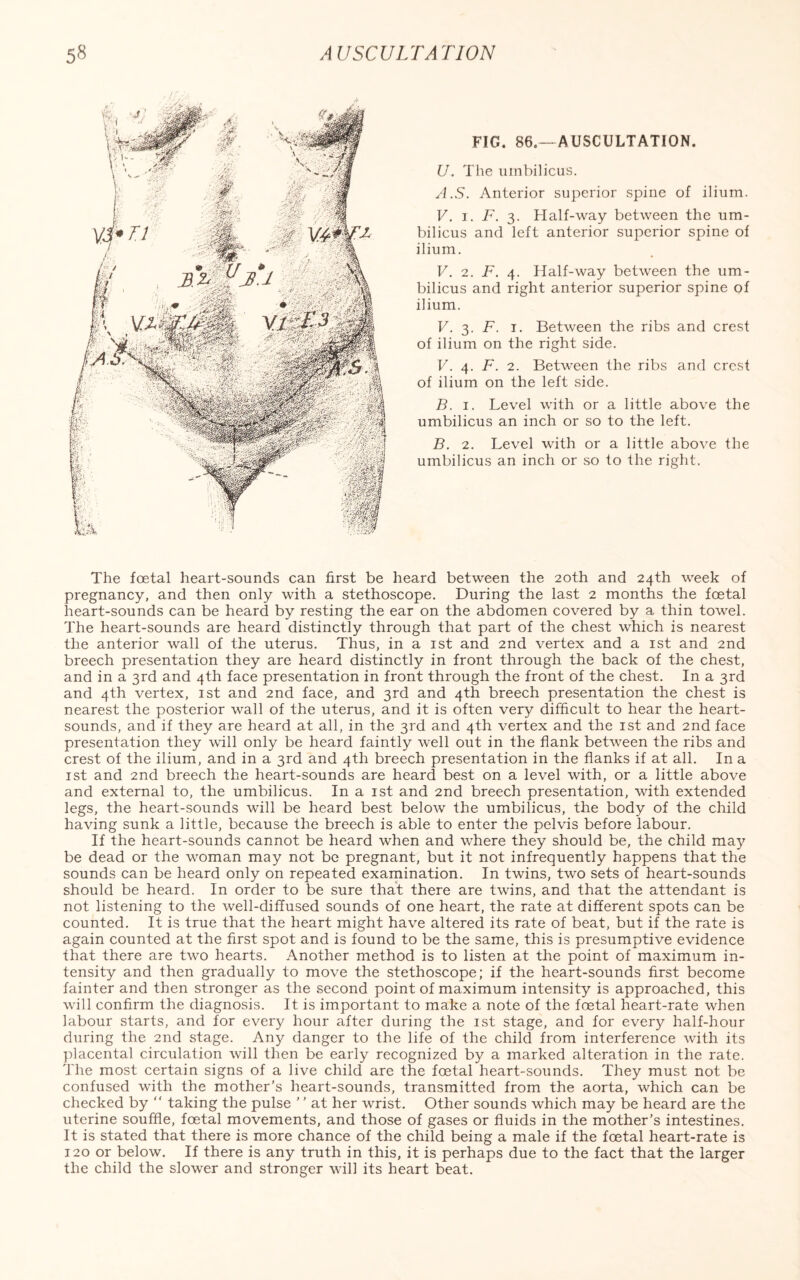 5« A USCULTATION FIG. 86.—AUSCULTATION. U. The umbilicus. A. S. Anterior superior spine of ilium. V. i. F. 3. Half-way between the um¬ bilicus and left anterior superior spine of ilium. V. 2. F. 4. Half-way between the um¬ bilicus and right anterior superior spine of ilium. V. 3. F. 1. Between the ribs and crest of ilium on the right side. V. 4. F. 2. Between the ribs and crest of ilium on the left side. B. 1. Level with or a little above the umbilicus an inch or so to the left. B. 2. Level with or a little above the umbilicus an inch or so to the right. The foetal heart-sounds can first be heard between the 20th and 24th week of pregnancy, and then only with a stethoscope. During the last 2 months the foetal heart-sounds can be heard by resting the ear on the abdomen covered by a thin towel. The heart-sounds are heard distinctly through that part of the chest which is nearest the anterior wall of the uterus. Thus, in a 1st and 2nd vertex and a 1st and 2nd breech presentation they are heard distinctly in front through the back of the chest, and in a 3rd and 4th face presentation in front through the front of the chest. In a 3rd and 4th vertex, 1st and 2nd face, and 3rd and 4th breech presentation the chest is nearest the posterior wall of the uterus, and it is often very difficult to hear the heart- sounds, and if they are heard at all, in the 3rd and 4th vertex and the 1st and 2nd face presentation they will only be heard faintly well out in the flank between the ribs and crest of the ilium, and in a 3rd and 4th breech presentation in the flanks if at all. In a 1st and 2nd breech the heart-sounds are heard best on a level with, or a little above and external to, the umbilicus. In a 1st and 2nd breech presentation, with extended legs, the heart-sounds will be heard best below the umbilicus, the body of the child having sunk a little, because the breech is able to enter the pelvis before labour. If the heart-sounds cannot be heard -when and where they should be, the child may be dead or the woman may not be pregnant, but it not infrequently happens that the sounds can be heard only on repeated examination. In twins, two sets of heart-sounds should be heard. In order to be sure that there are twins, and that the attendant is not listening to the well-diffused sounds of one heart, the rate at different spots can be counted. It is true that the heart might have altered its rate of beat, but if the rate is again counted at the first spot and is found to be the same, this is presumptive evidence that there are two hearts. Another method is to listen at the point of maximum in¬ tensity and then gradually to move the stethoscope; if the heart-sounds first become fainter and then stronger as the second point of maximum intensity is approached, this will confirm the diagnosis. It is important to make a note of the foetal heart-rate when labour starts, and for every hour after during the 1st stage, and for every half-hour during the 2nd stage. Any danger to the life of the child from interference with its placental circulation will then be early recognized by a marked alteration in the rate. The most certain signs of a live child are the foetal heart-sounds. They must not be confused with the mother’s heart-sounds, transmitted from the aorta, which can be checked by  taking the pulse ' ’ at her wrist. Other sounds which may be heard are the uterine souffle, foetal movements, and those of gases or fluids in the mother’s intestines. It is stated that there is more chance of the child being a male if the foetal heart-rate is 120 or below. If there is any truth in this, it is perhaps due to the fact that the larger the child the slower and stronger will its heart beat.