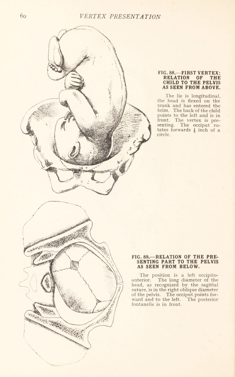 FIG. 88.—FIRST VERTEX: RELATION OF THE CHILD TO THE PELVIS AS SEEN FROM ABOVE. The lie is longitudinal, the head is flexed on the trunk and has entered the brim. The back of the child points to the left and is in front. The vertex is pre¬ senting. The occiput ro¬ tates forwards £ inch of a circle. FIG. 89—RELATION OF THE PRE¬ SENTING PART TO THE PELVIS AS SEEN FROM BELOW. The position is a left occipito¬ anterior. The long diameter of the head, as recognized by the sagittal suture, is in the right oblique diameter of the pelvis. The occiput points for¬ ward and to the left. The posterior fontanelle is in front.