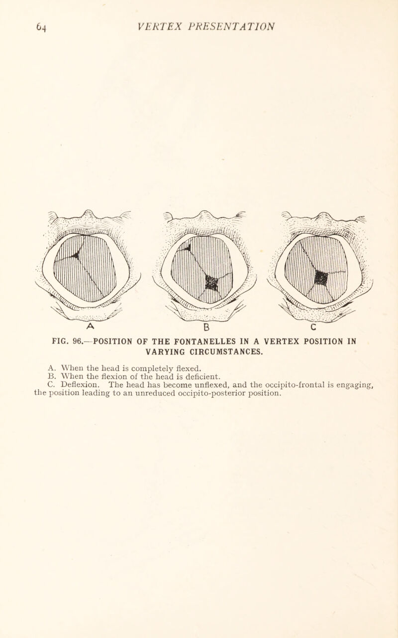 VARYING CIRCUMSTANCES. A. When the head is completely flexed. B. When the flexion of the head is deficient. C. Deflexion. The head has become unflexed, and the occipito-frontal is engaging, the position leading to an unreduced occipito-posterior position.