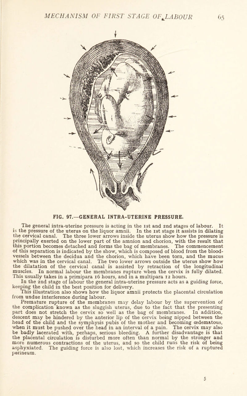 SL I FIG. 97.—GENERAL INTRA-UTERINE PRESSURE. The general intra-uterine pressure is acting in the ist and 2nd stages of labour. It is the pressure of the uterus on the liquor amnii. In the ist stage it assists in dilating the cervical canal. The three lower arrows inside the uterus show how the pressure is principally exerted on the lower part of the amnion and chorion, with the result that this portion becomes detached and forms the bag of membranes. The commencement of this separation is indicated by the show, which is composed of blood from the blood¬ vessels between the decidua and the chorion, which have been torn, and the mucus which was in the cervical canal. The two lower arrows outside the uterus show how the dilatation of the cervical canal is assisted by retraction of the longitudinal muscles. In normal labour the membranes rupture when the cervix is fully dilated. This usually takes in a primipara 16 hours, and in a multipara 12 hours. In the 2nd stage of labour the general intra-uterine pressure acts as a guiding force, keeping the child in the best position for delivery. This illustration also shows how the liquor amnii protects the placental circulation from undue interference during labour. Premature rupture of the membranes may delay labour by the supervention of the complication known as the sluggish uterus, due to the fact that the presenting part does not stretch the cervix so well as the bag of membranes. In addition, descent may be hindered by the anterior lip of the cervix being nipped between the head of the child and the symphysis pubis of the mother and becoming cedematous, when it must be pushed over the head in an interval of a pain. The cervix may also be badly lacerated with, perhaps, serious bleeding. A further disadvantage is that the placental circulation is disturbed more often than normal by the stronger and more numerous contractions of the uterus, and so the child runs the risk of being asphyxiated. The guiding force is also lost, which increases the risk of a ruptured perineum.