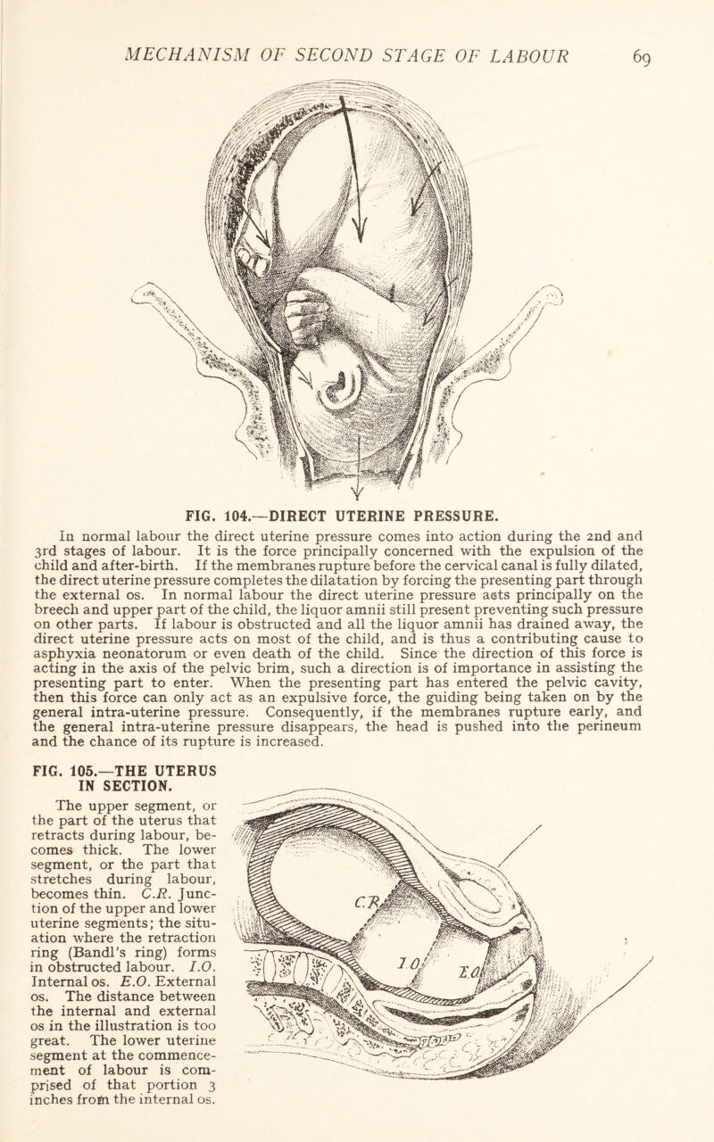 In normal labour the direct uterine pressure comes into action during the 2nd and 3rd stages of labour. It is the force principally concerned with the expulsion of the child and after-birth. If the membranes rupture before the cervical canal is fully dilated, the direct uterine pressure completes the dilatation by forcing the presenting part through the external os. In normal labour the direct uterine pressure acts principally on the breech and upper part of the child, the liquor amnii still present preventing such pressure on other parts. If labour is obstructed and all the liquor amnii has drained away, the direct uterine pressure acts on most of the child, and is thus a contributing cause to asphyxia neonatorum or even death of the child. Since the direction of this force is acting in the axis of the pelvic brim, such a direction is of importance in assisting the presenting part to enter. When the presenting part has entered the pelvic cavity, then this force can only act as an expulsive force, the guiding being taken on by the general intra-uterine pressure. Consequently, if the membranes rupture early, and the general intra-uterine pressure disappears, the head is pushed into the perineum and the chance of its rupture is increased. FIG. 105.—THE UTERUS IN SECTION. The upper segment, or the part of the uterus that retracts during labour, be¬ comes thick. The lower segment, or the part that stretches during labour, becomes thin. C.R. Junc¬ tion of the upper and lower uterine segments; the situ¬ ation where the retraction ring (Bandl’s ring) forms in obstructed labour. I.O. Internal os. E.O. External os. The distance between the internal and external os in the illustration is too great. The lower uterine segment at the commence¬ ment of labour is com¬ prised of that portion 3 inches from the internal os.