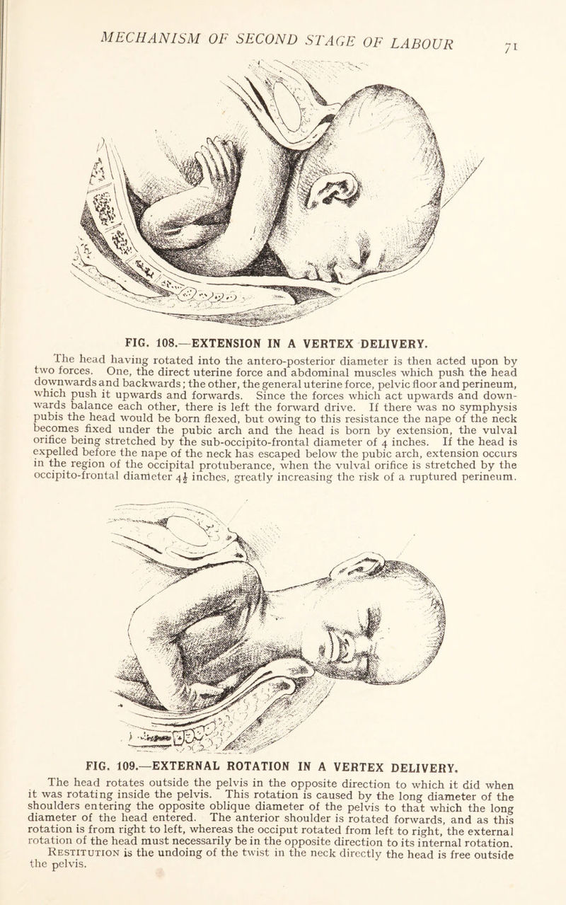 FIG. 108.—EXTENSION IN A VERTEX DELIVERY. Ihe head having rotated into the antero-posterior diameter is then acted upon by two forces. One, the direct uterine force and abdominal muscles which push the head downwards and backwards; the other, the general uterine force, pelvic floor and perineum, which push it upwards and forwards. Since the forces which act upwards and down¬ wards balance each other, there is left the forward drive. If there was no symphysis pubis the head would be born flexed, but owing to this resistance the nape of the neck becomes fixed under the pubic arch and the head is born by extension, the vulval orifice being stretched by the sub-occipito-frontal diameter of 4 inches. If the head is expelled before the nape of the neck has escaped below the pubic arch, extension occurs in the region of the occipital protuberance, when the vulval orifice is stretched by the occipito-frontal diameter 4 J inches, greatly increasing the risk of a ruptured perineum. FIG. 109.—EXTERNAL ROTATION IN A VERTEX DELIVERY, The head rotates outside the pelvis in the opposite direction to which it did when it was rotating inside the pelvis. This rotation is caused by the long diameter of the shoulders entering the opposite oblique diameter of the pelvis to that which the long diameter of the head entered. The anterior shoulder is rotated forwards, and as this rotation is from right to left, whereas the occiput rotated from left to right,’the external rotation of the head must necessarily be in the opposite direction to its internal rotation. Restitution is the undoing of the twist in the neck directly the head is free outside the pelvis.