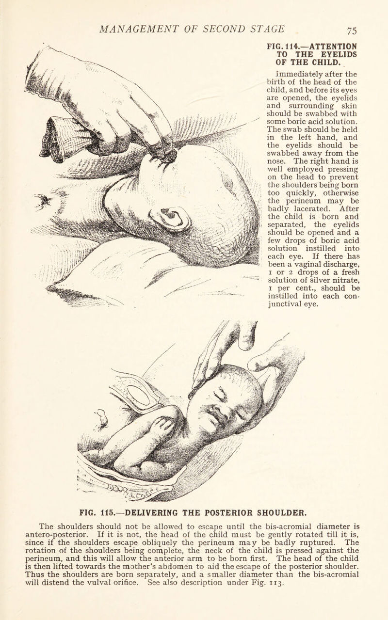 ~ : ■ • A..., FIG. 114.—ATTENTION TO THE EYELIDS OF THE CHILD. Immediately after the birth of the head of the child, and before its eyes are opened, the eyelids and surrounding skin should be swabbed with some boric acid solution. The swab should be held in the left hand, and the eyelids should be swabbed away from the nose. The right hand is well employed pressing on the head to prevent the shoulders being born too quickly, otherwise the perineum may be badly lacerated. After the child is born and separated, the eyelids should be opened and a few drops of boric acid solution instilled into each eye. If there has been a vaginal discharge, i or 2 drops of a fresh solution of silver nitrate, i per cent., should be instilled into each con¬ junctival eye. FIG. 115.—DELIVERING THE POSTERIOR SHOULDER. The shoulders should not be allowed to escape until the bis-acromial diameter is antero-posterior. If it is not, the head of the child must be gently rotated till it is, since if the shoulders escape obliquely the perineum may be badly ruptured. The rotation of the shoulders being complete, the neck of the child is pressed against the perineum, and this will allow the anterior arm to be born first. The head of the child is then lifted towards the mother’s abdomen to aid the escape of the posterior shoulder. Thus the shoulders are born separately, and a smaller diameter than the bis-acromial will distend the vulval orifice. See also description under Fig. 113.