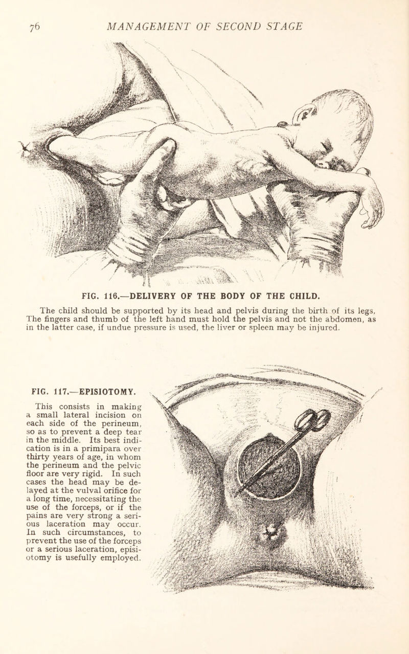 7 FIG. 116.—DELIVERY OF THE BODY OF THE CHILD. The child should be supported by its head and pelvis during the birth of its legs, The fingers and thumb of the left hand must hold the pelvis and not the abdomen, as in the latter case, if undue pressure is used, the liver or spleen may be injured. FIG. 117.—EPISIOTOMY. This consists in making a small lateral incision on each side of the perineum, so as to prevent a deep tear in the middle. Its best indi¬ cation is in a primipara over thirty years of age, in whom the perineum and the pelvic floor are very rigid. In such cases the head may be de¬ layed at the vulval orifice for a long time, necessitating the use of the forceps, or if the pains are very strong a seri¬ ous laceration may occur. In such circumstances, to prevent the use of the forceps or a serious laceration, episi- otomy is usefully employed.