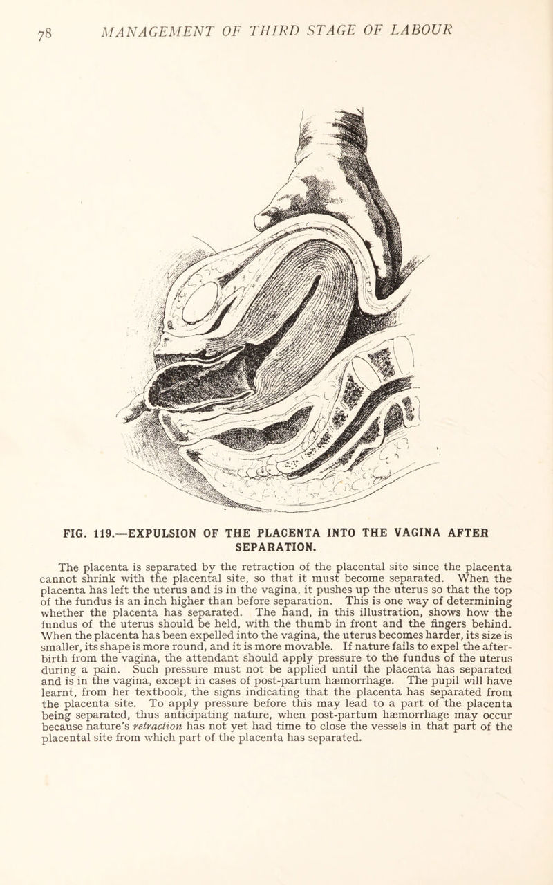 FIG. 119—EXPULSION OF THE PLACENTA INTO THE VAGINA AFTER SEPARATION. The placenta is separated by the retraction of the placental site since the placenta cannot shrink with the placental site, so that it must become separated. When the placenta has left the uterus and is in the vagina, it pushes up the uterus so that the top of the fundus is an inch higher than before separation. This is one way of determining whether the placenta has separated. The hand, in this illustration, shows how the fundus of the uterus should be held, with the thumb in front and the fingers behind. When the placenta has been expelled into the vagina, the uterus becomes harder, its size is smaller, its shape is more round, and it is more movable. If nature fails to expel the after¬ birth from the vagina, the attendant should apply pressure to the fundus of the uterus during a pain. Such pressure must not be applied until the placenta has separated and is in the vagina, except in cases of post-partum haemorrhage. The pupil will have learnt, from her textbook, the signs indicating that the placenta has separated from the placenta site. To apply pressure before this may lead to a part of the placenta being separated, thus anticipating nature, when post-partum haemorrhage may occur because nature's retraction has not yet had time to close the vessels in that part of the placental site from which part of the placenta has separated.