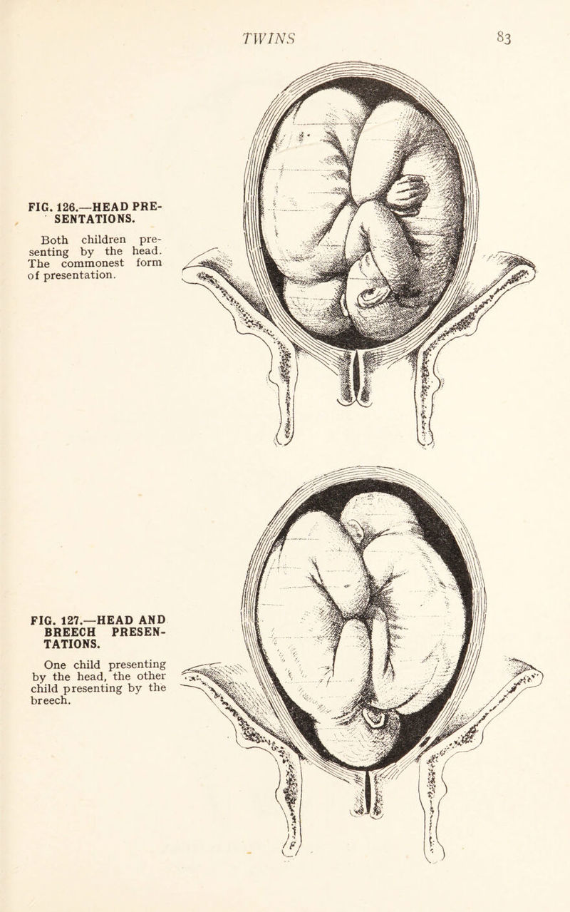 FIG. 126.—HEAD PRE¬ SENTATIONS. Both children pre¬ senting by the head. The commonest form of presentation. FIG. 127.—HEAD AND BREECH PRESEN¬ TATIONS. One child presenting by the head, the other child presenting by the breech.