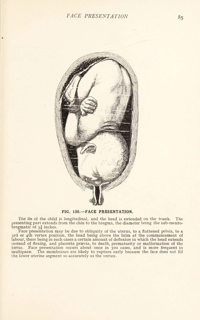 FIG. 130.—FACE PRESENTATION. The lie of the child is longitudinal, and the head is extended on the trunk. The presenting part extends from the chin to the bregma, the diameter being the sub-mento- bregmatic of 3I inches. Face presentation may be due to obliquity of the uterus, to a flattened pelvis, to a 3rd or 4th vertex position, the head being above the brim at the commencement of labour, there being in such cases a certain amount of deflexion in which the head extends instead of flexing, and placenta praevia, to death, prematurity or malformation of the foetus. Face presentation occurs about once in 300 cases, and is more frequent in multiparae. The membranes are likely to rupture early because the face does not fill the lower uterine segment so accurately as the vertex.