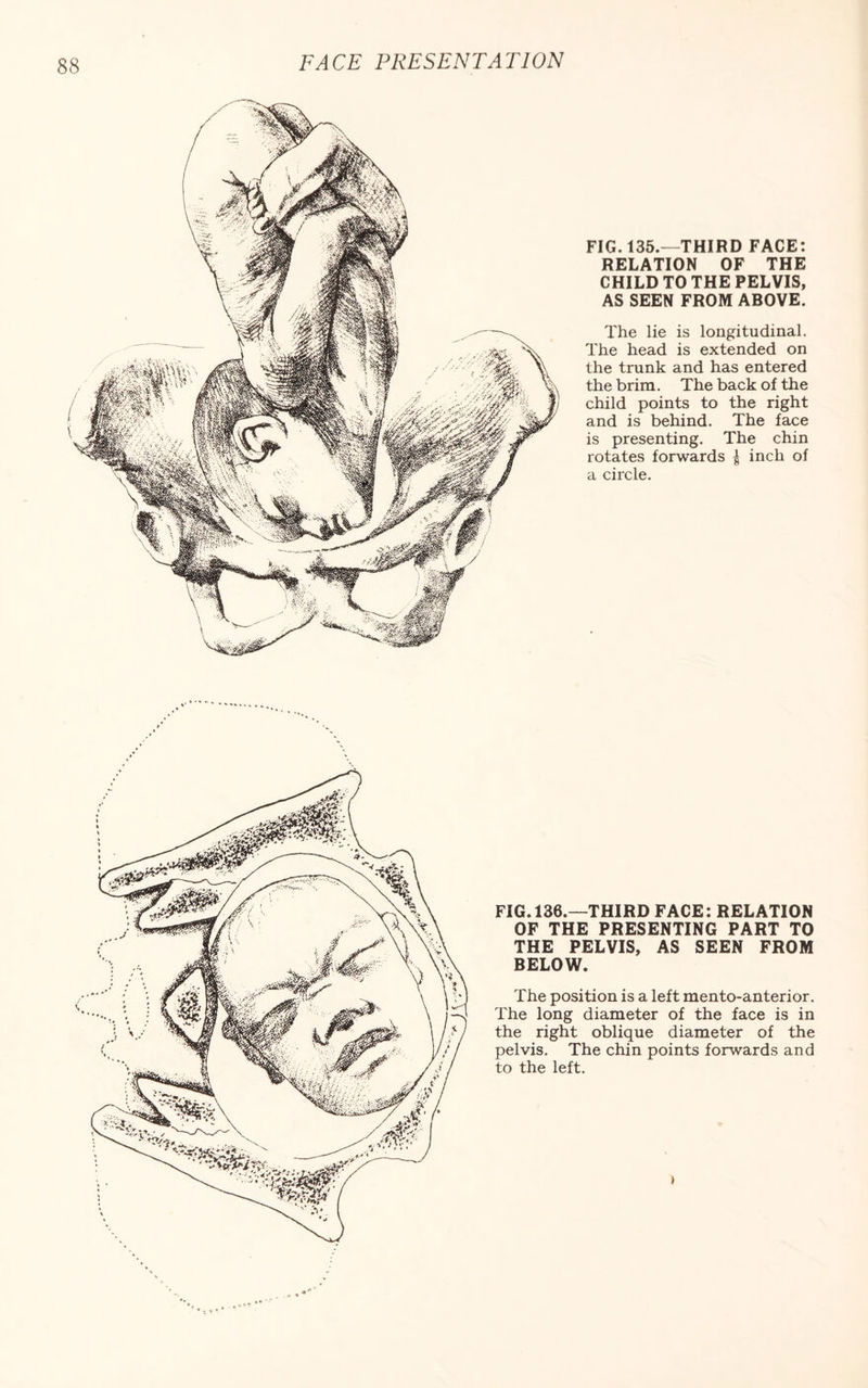 FIG. 135.—THIRD FACE: RELATION OF THE CHILD TO THE PELVIS, AS SEEN FROM ABOVE. The lie is longitudinal. The head is extended on the trunk and has entered the brim. The back of the child points to the right and is behind. The face is presenting. The chin rotates forwards | inch of a circle. FIG. 136.—THIRD FACE: RELATION OF THE PRESENTING PART TO THE PELVIS, AS SEEN FROM BELOW. The position is a left mento-anterior. The long diameter of the face is in the right oblique diameter of the pelvis. The chin points forwards and to the left.