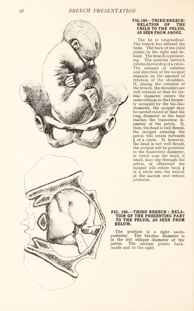 FIG.149.—THIRD BREECH: RELATION OF THE CHILD TO THE PELVIS, AS SEEN FROM ABOVE. The lie is longitudinal. The breech has entered the brim. The back of the child points to the right and be¬ hind. The breech is present¬ ing. The anterior buttock rotates forwards £ of a circle. The amopnt of rotation and direction of the occiput depends on the amount of rotation of the shoulders. If, during the rotation of the breech, the shoulders are well rotated so that its bis- iliac diameter enters the same oblique as that former¬ ly occupied by the bis-iliac diameter, the occiput may be carried round so that the long diameter of the head reaches the transverse di¬ ameter of the pelvis. If, then, the head is well flexed, the occiput entering the pelvis will rotate forwards f of a circle. If, however, the head is not well flexed, the occiput will be posterior to the transverse diameter, in which case the head, if small, may slip through the pelvis, or otherwise the occiput will rotate back £ of a circle into the hollow of the sacrum and remain posterior. FIG. 150.—THIRD BREECH : RELA¬ TION OF THE PRESENTING PART TO THE PELVIS, AS SEEN FROM BELOW. The position is a right sacro¬ posterior. The bis-iliac diameter is in the left oblique diameter of the pelvis. The sacrum points back¬ wards and to the right.