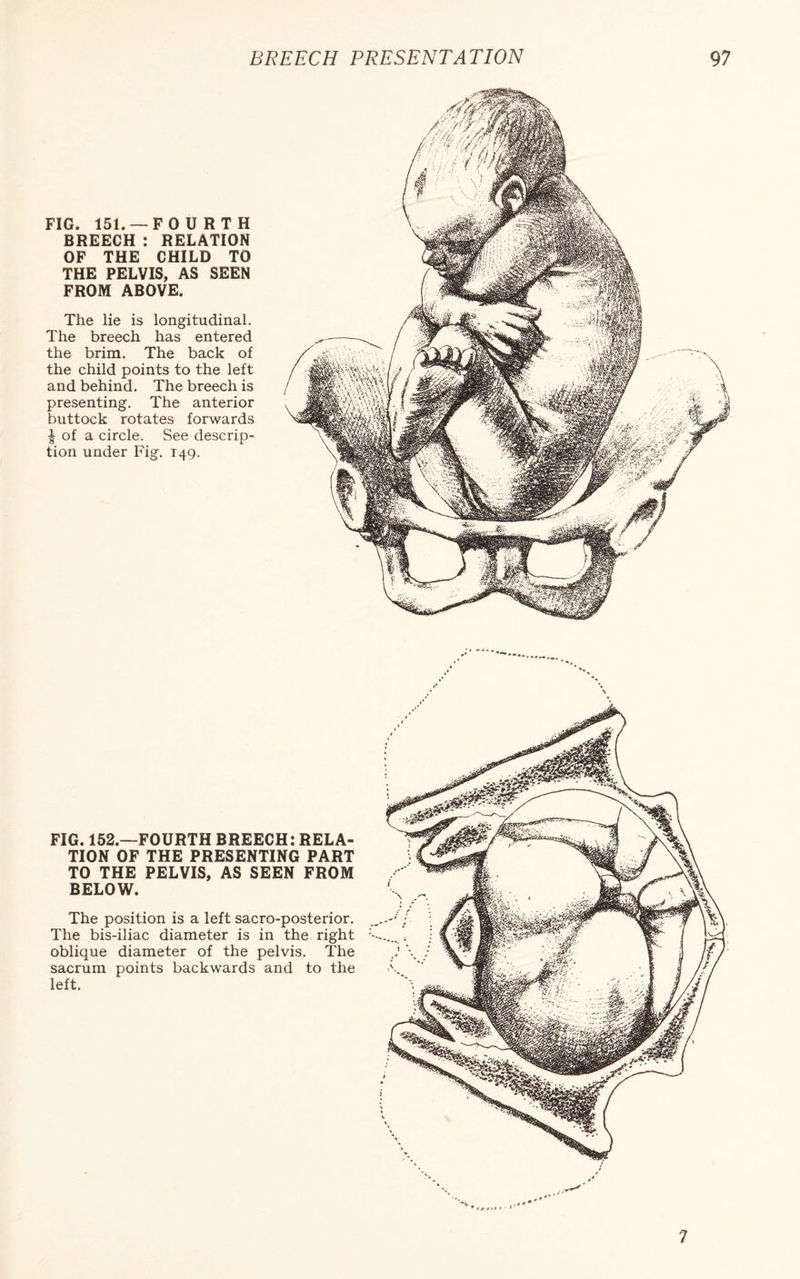 FIG. 151. — FOURTH BREECH : RELATION OF THE CHILD TO THE PELVIS, AS SEEN FROM ABOVE. The lie is longitudinal. The breech has entered the brim. The back of the child points to the left and behind. The breech is presenting. The anterior buttock rotates forwards | of a circle. See descrip¬ tion under Fig. 149. ' '-.V FIG. 152.—FOURTH BREECH: RELA¬ TION OF THE PRESENTING PART TO THE PELVIS, AS SEEN FROM BELOW. The position is a left sacro-posterior. The bis-iliac diameter is in the right oblique diameter of the pelvis. The sacrum points backwards and to the left. 7