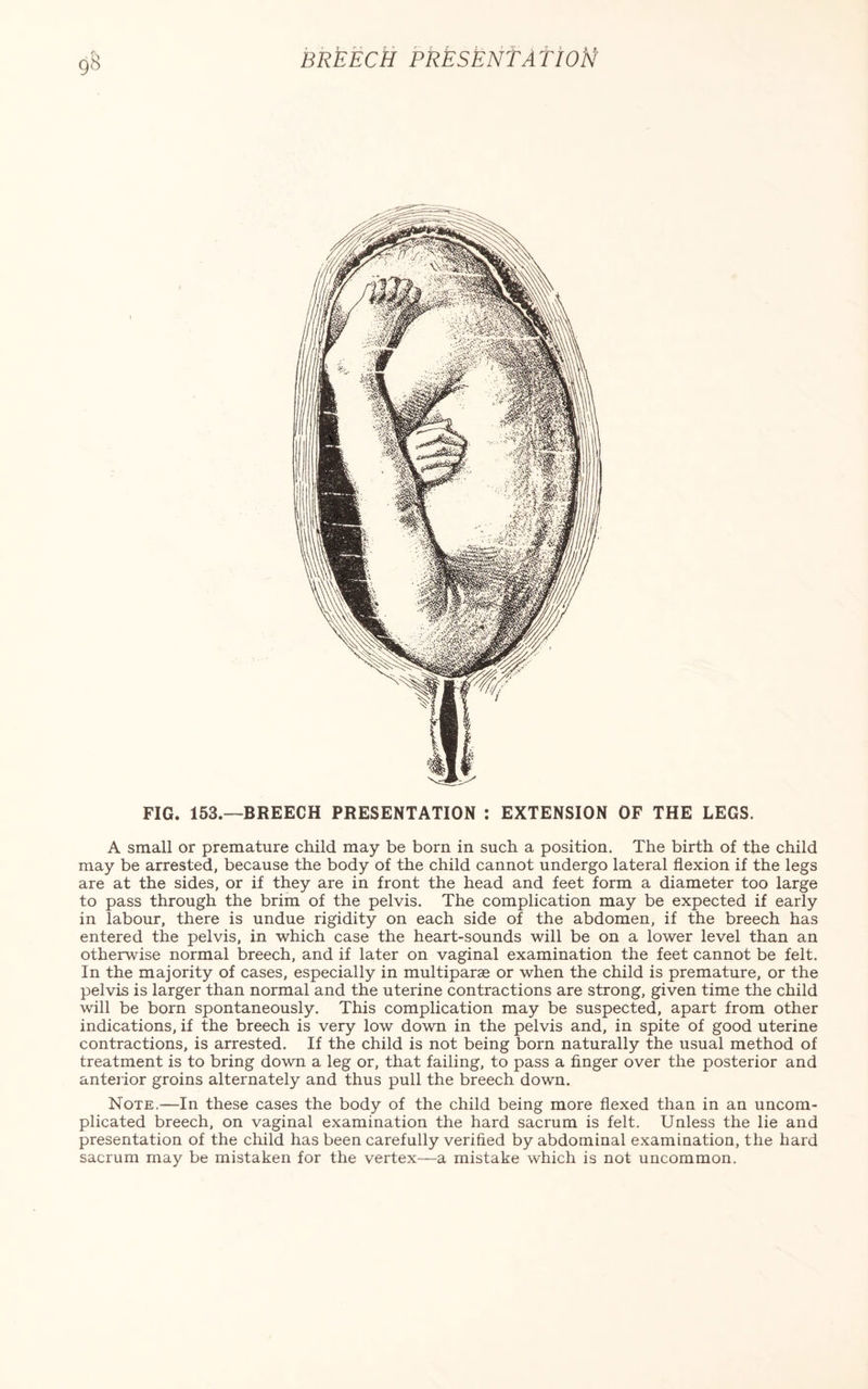 FIG. 153.—BREECH PRESENTATION : EXTENSION OF THE LEGS. A small or premature child may be born in such a position. The birth of the child may be arrested, because the body of the child cannot undergo lateral flexion if the legs are at the sides, or if they are in front the head and feet form a diameter too large to pass through the brim of the pelvis. The complication may be expected if early in labour, there is undue rigidity on each side of the abdomen, if the breech has entered the pelvis, in which case the heart-sounds will be on a lower level than an otherwise normal breech, and if later on vaginal examination the feet cannot be felt. In the majority of cases, especially in multiparae or when the child is premature, or the pelvis is larger than normal and the uterine contractions are strong, given time the child will be born spontaneously. This complication may be suspected, apart from other indications, if the breech is very low down in the pelvis and, in spite of good uterine contractions, is arrested. If the child is not being born naturally the usual method of treatment is to bring down a leg or, that failing, to pass a finger over the posterior and anterior groins alternately and thus pull the breech down. Note.—In these cases the body of the child being more flexed than in an uncom¬ plicated breech, on vaginal examination the hard sacrum is felt. Unless the lie and presentation of the child has been carefully verified by abdominal examination, the hard sacrum may be mistaken for the vertex—a mistake which is not uncommon.