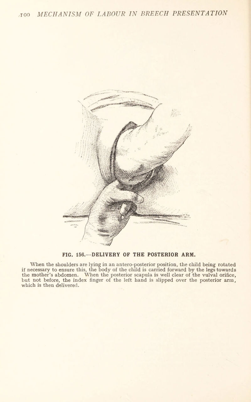 FIG. 156.—DELIVERY OF THE POSTERIOR ARM. When the shoulders are lying in an antero-posterior position, the child being rotated if necessary to ensure this, the body of the child is carried forward by the legs towards the mother’s abdomen. When the posterior scapula is well clear of the vulval orifice, but not before, the index finger of the left hand is slipped over the posterior arm, which is then delivered.