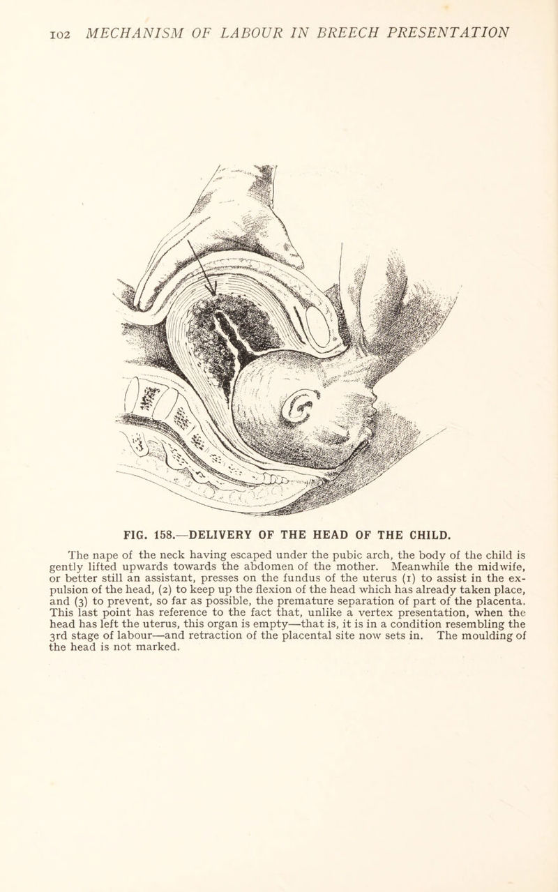 FIG. 158.—DELIVERY OF THE HEAD OF THE CHILD. The nape of the neck having escaped under the pubic arch, the body of the child is gently lifted upwards to-wards the abdomen of the mother. Meanwhile the midwife, or better still an assistant, presses on the fundus of the uterus (i) to assist in the ex¬ pulsion of the head, (2) to keep up the flexion of the head which has already taken place, and (3) to prevent, so far as possible, the premature separation of part of the placenta. This last point has reference to the fact that, unlike a vertex presentation, when the head has left the uterus, this organ is empty—that is, it is in a condition resembling the 3rd stage of labour—and retraction of the placental site now sets in. The moulding of the head is not marked.