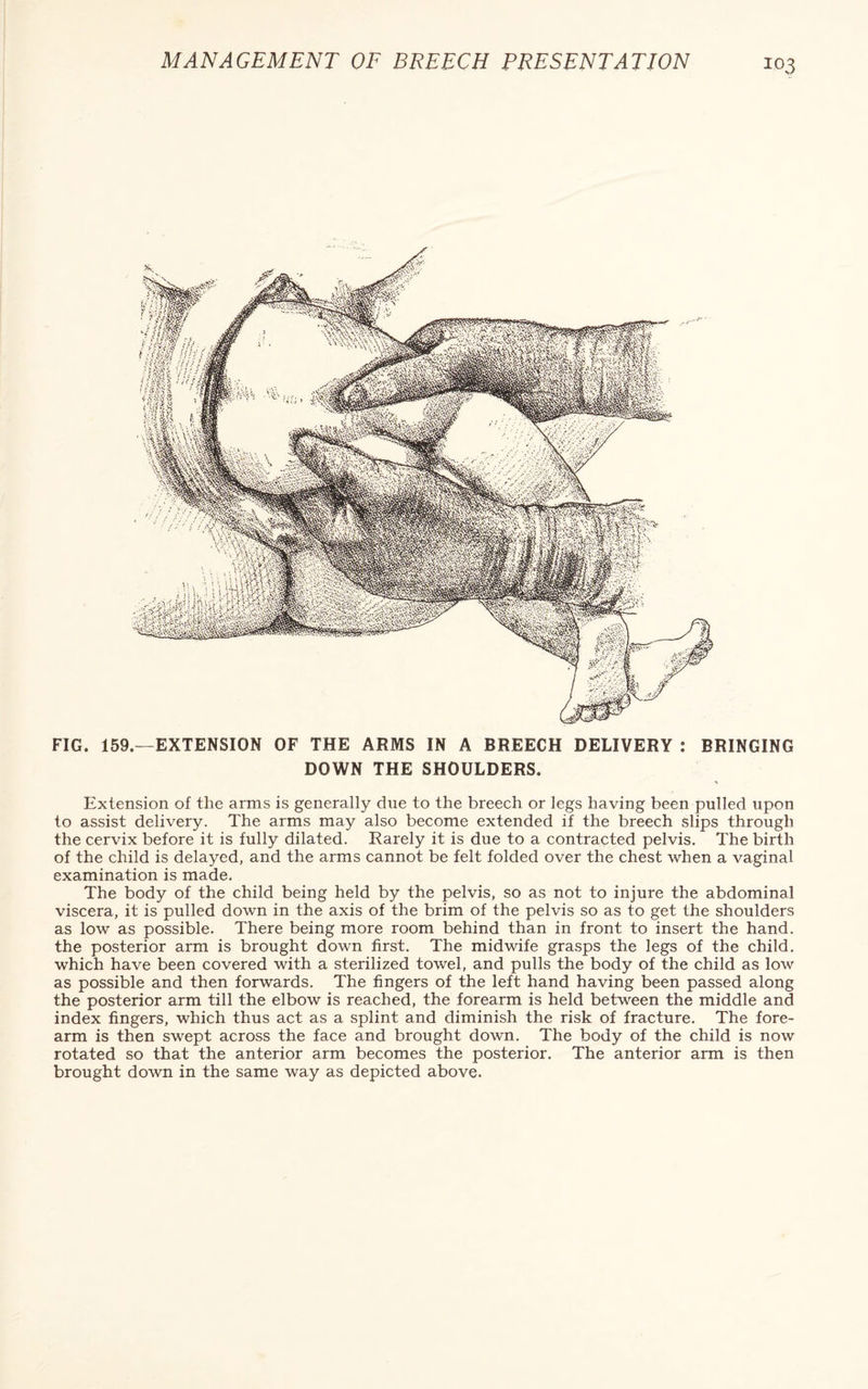 FIG. 159.—EXTENSION OF THE ARMS IN A BREECH DELIVERY : BRINGING DOWN THE SHOULDERS. * Extension of the arms is generally due to the breech or legs having been pulled upon to assist delivery. The arms may also become extended if the breech slips through the cervix before it is fully dilated. Rarely it is due to a contracted pelvis. The birth of the child is delayed, and the arms cannot be felt folded over the chest when a vaginal examination is made. The body of the child being held by the pelvis, so as not to injure the abdominal viscera, it is pulled down in the axis of the brim of the pelvis so as to get the shoulders as low as possible. There being more room behind than in front to insert the hand, the posterior arm is brought down first. The midwife grasps the legs of the child, which have been covered with a sterilized towel, and pulls the body of the child as low as possible and then forwards. The fingers of the left hand having been passed along the posterior arm till the elbow is reached, the forearm is held between the middle and index fingers, which thus act as a splint and diminish the risk of fracture. The fore¬ arm is then swept across the face and brought down. The body of the child is now rotated so that the anterior arm becomes the posterior. The anterior arm is then brought down in the same way as depicted above.