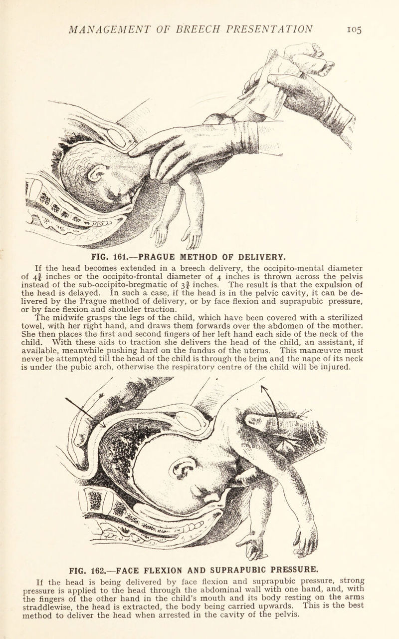 If the head becomes extended in a breech delivery, the occipito-mental diameter of 41 inches or the occipito-frontal diameter of 4 inches is thrown across the pelvis instead of the sub-occipito-bregmatic of 3f inches. The result is that the expulsion of the head is delayed. In such a case, if the head is in the pelvic cavity, it can be de¬ livered by the Prague method of delivery, or by face flexion and suprapubic pressure, or by face flexion and shoulder traction. The midwife grasps the legs of the child, which have been covered with a sterilized towel, with her right hand, and draws them forwards over the abdomen of the mother. She then places the first and second fingers of her left hand each side of the neck of the child. With these aids to traction she delivers the head of the child, an assistant, if available, meanwhile pushing hard on the fundus of the uterus. This manoeuvre must never be attempted till the head of the child is through the brim and the nape of its neck is under the pubic arch, otherwise the respiratory centre of the child will be injured. FIG. 162.—FACE FLEXION AND SUPRAPUBIC PRESSURE. If the head is being delivered by face flexion and suprapubic pressure, strong pressure is applied to the head through the abdominal wall with one hand, and, with the fingers of the other hand in the child’s mouth and its body resting on the arms straddlewise, the head is extracted, the body being carried upwards. This is the best method to deliver the head when arrested in the cavity of the pelvis.