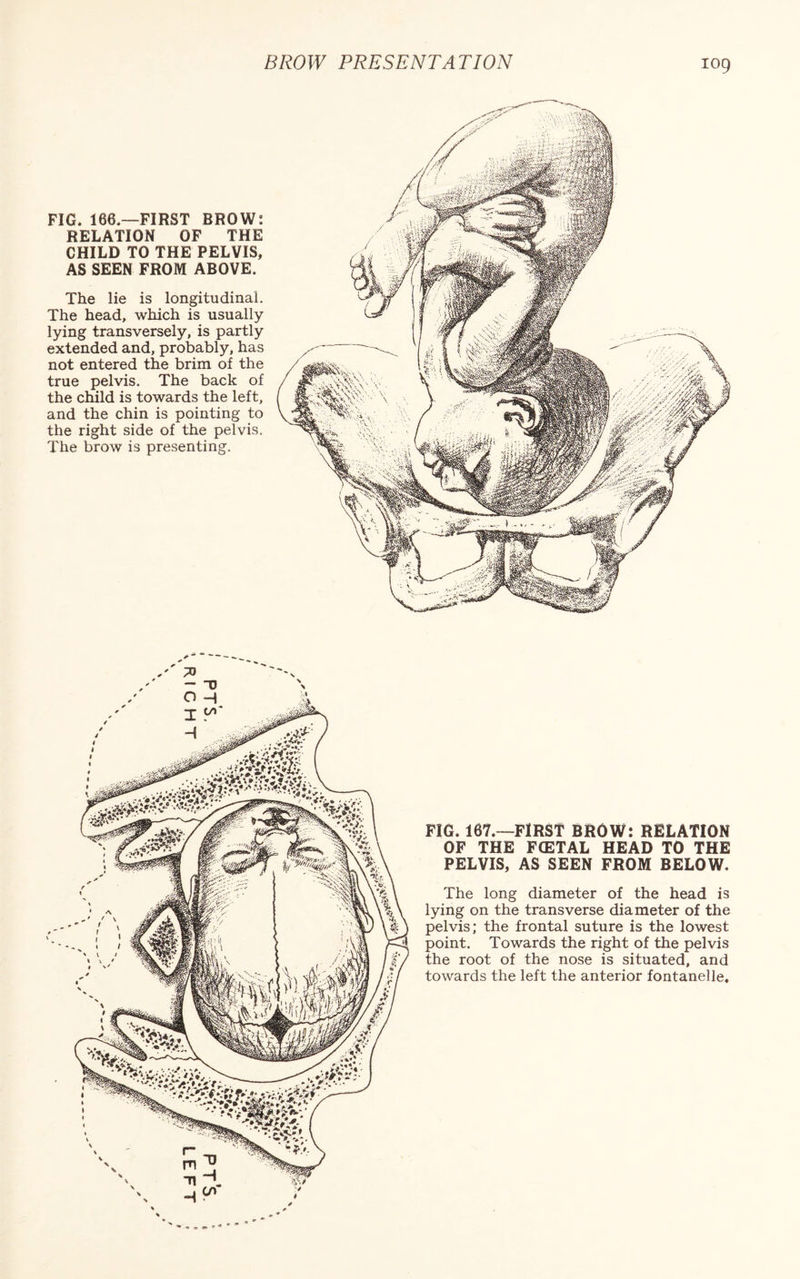 FIG. 166—FIRST BROW: RELATION OF THE CHILD TO THE PELVIS, AS SEEN FROM ABOVE. The lie is longitudinal. The head, which is usually lying transversely, is partly extended and, probably, has not entered the brim of the true pelvis. The back of the child is towards the left, and the chin is pointing to the right side of the pelvis. The brow is presenting. FIG. 167.—FIRST BROW: RELATION OF THE FCETAL HEAD TO THE PELVIS, AS SEEN FROM BELOW. The long diameter of the head is lying on the transverse diameter of the pelvis; the frontal suture is the lowest point. Towards the right of the pelvis the root of the nose is situated, and towards the left the anterior fontanelle. I