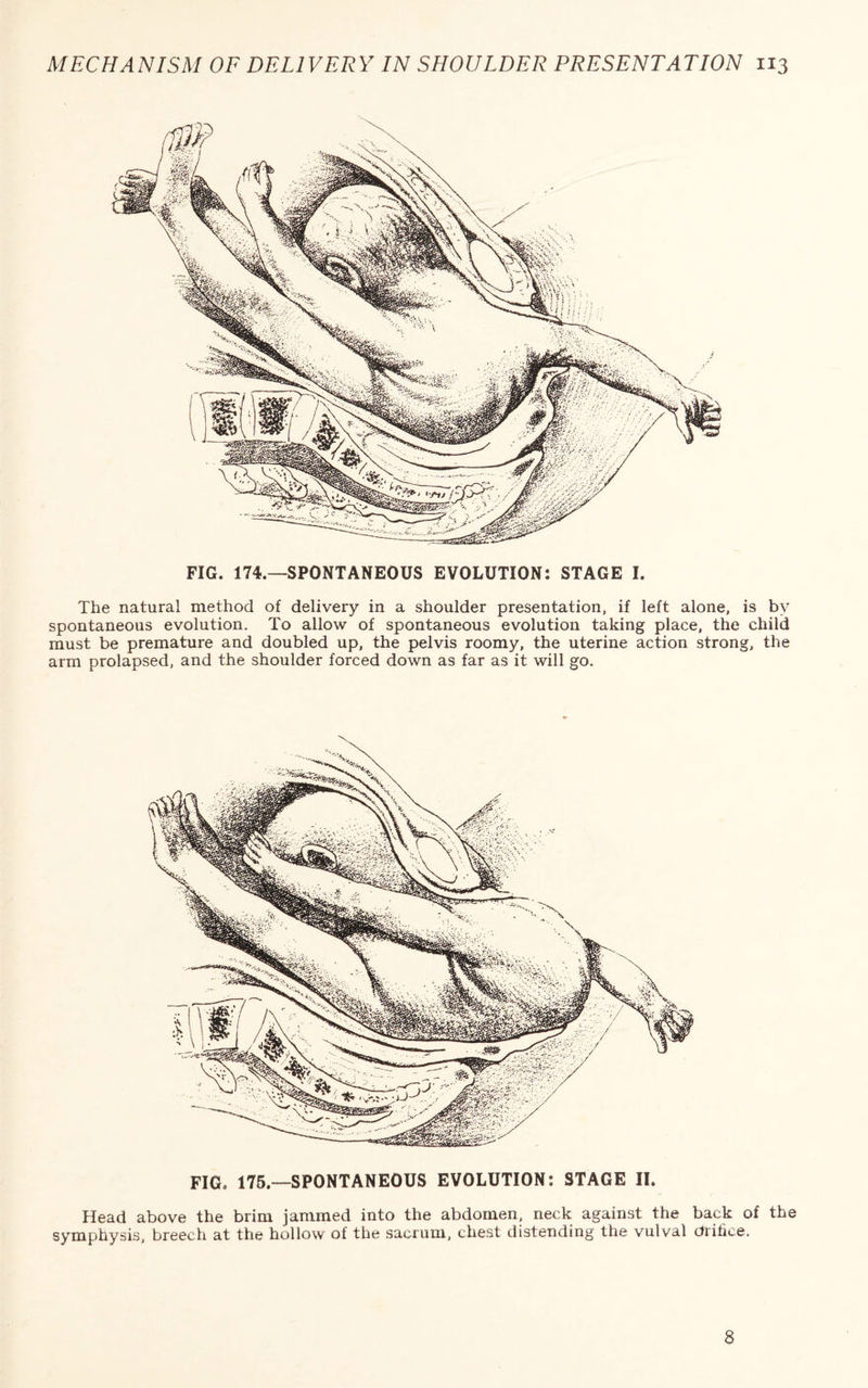 FIG. 174.—SPONTANEOUS EVOLUTION: STAGE I. The natural method of delivery in a shoulder presentation, if left alone, is by spontaneous evolution. To allow of spontaneous evolution taking place, the child must be premature and doubled up, the pelvis roomy, the uterine action strong, the arm prolapsed, and the shoulder forced down as far as it will go. FIG, 175.—SPONTANEOUS EVOLUTION: STAGE II. Head above the brim jammed into the abdomen, neck against the back of the symphysis, breech at the hollow of the sacrum, chest distending the vulval ctrifice. 8