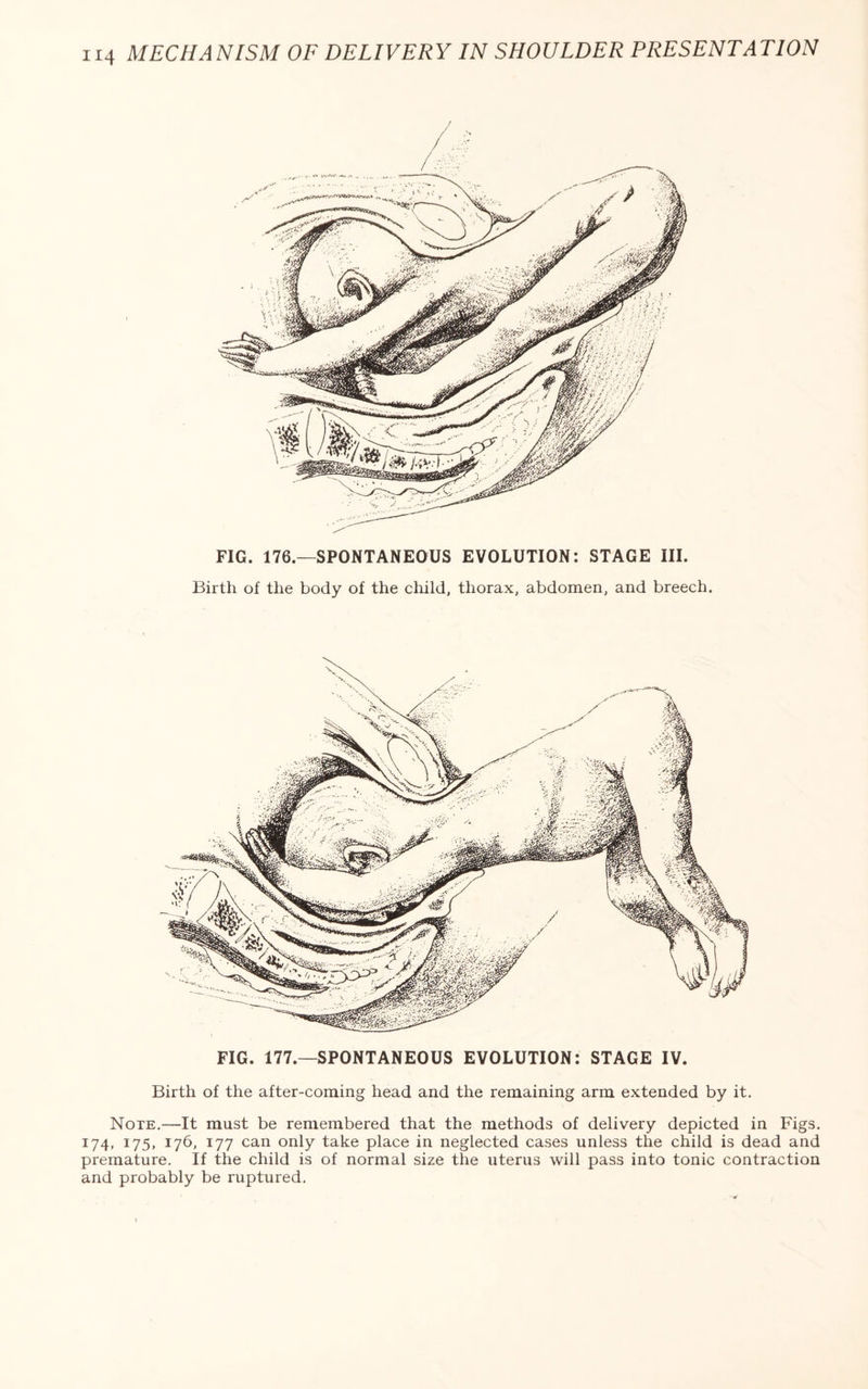 FIG. 176.—SPONTANEOUS EVOLUTION: STAGE III. Birth of the body of the child, thorax, abdomen, and breech. FIG. 177—SPONTANEOUS EVOLUTION: STAGE IV. Birth of the after-coming head and the remaining arm extended by it. Note.—It must be remembered that the methods of delivery depicted in Figs. 174, 175, 176, 177 can only take place in neglected cases unless the child is dead and premature. If the child is of normal size the uterus will pass into tonic contraction and probably be ruptured.