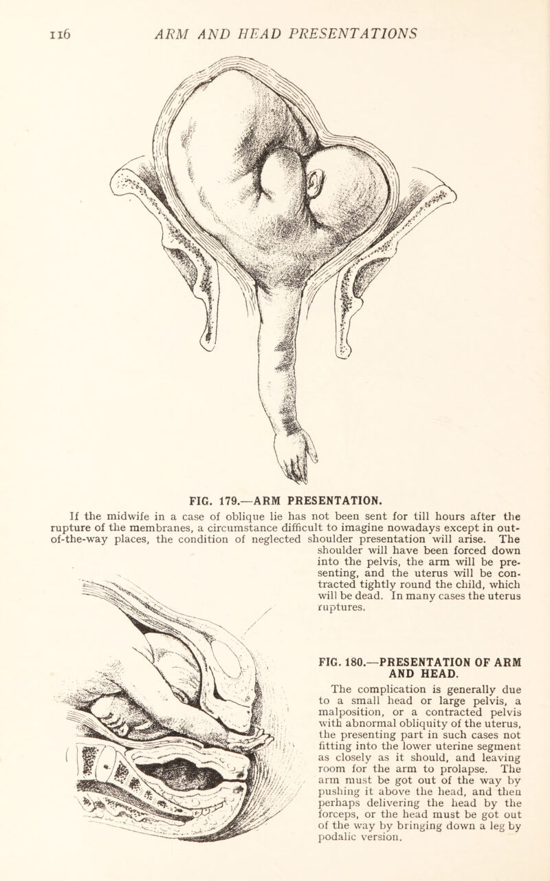 FIG. 179.—ARM PRESENTATION. If the midwife in a case of oblique lie has not been sent for till hours after the rupture of the membranes, a circumstance difficult to imagine nowadays except in out- of-the-way places, the condition of neglected shoulder presentation will arise. The shoulder will have been forced down into the pelvis, the arm will be pre¬ senting, and the uterus will be con¬ tracted tightly round the child, which will be dead. In many cases the uterus ruptures. FIG. 180—PRESENTATION OF ARM AND HEAD. The complication is generally due to a small head or large pelvis, a malposition, or a contracted pelvis with abnormal obliquity of the uterus, the presenting part in such cases not fitting into the lower uterine segment as closely as it should, and leaving room for the arm to prolapse. The arm must be got out of the way by pushing it above the head, and then perhaps delivering the head by the forceps, or the head must be got out of the way by bringing down a leg by podalic version.