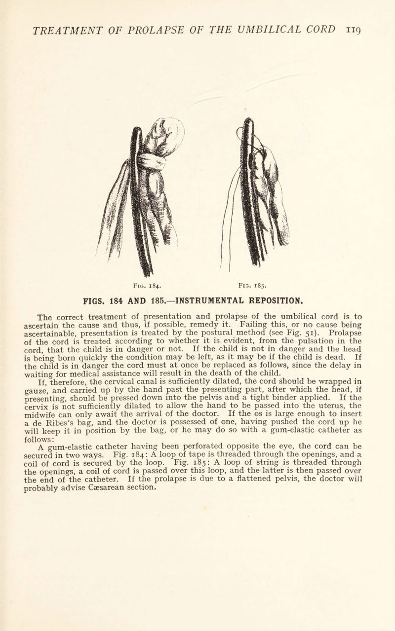 TREATMENT OF PROLAPSE OF THE UMBILICAL CORD ng Fig. 184. Fig. 185. FIGS. 184 AND 185.—INSTRUMENTAL REPOSITION. The correct treatment of presentation and prolapse of the umbilical cord is to ascertain the cause and thus, if possible, remedy it. Failing this, or no cause being ascertainable, presentation is treated by the postural method (see Fig. 51). Prolapse of the cord is treated according to whether it is evident, from the pulsation in the cord, that the child is in danger or not. If the child is not in danger and the head is being born quickly the condition may be left, as it may be if the child is dead. If the child is in danger the cord must at once be replaced as follows, since the delay in waiting for medical assistance will result in the death of the child. If, therefore, the cervical canal is sufficiently dilated, the cord should be wrapped in gauze, and carried up by the hand past the presenting part, after which the head, if presenting, should be pressed down into the pelvis and a tight binder applied. If the cervix is not sufficiently dilated to allow the hand to be passed into the uterus, the midwife can only await the arrival of the doctor. If the os is large enough to insert a de Ribes’s bag, and the doctor is possessed of one, having pushed the cord up he will keep it in position by the bag, or he may do so with a gum-elastic catheter as follows: A gum-elastic catheter having been perforated opposite the eye, the cord can be secured in two ways. Fig. 184: A loop of tape is threaded through the openings, and a coil of cord is secured by the loop. Fig. 185: A loop of string is threaded through the openings, a coil of cord is passed over this loop, and the latter is then passed over the end of the catheter. If the prolapse is due to a flattened pelvis, the doctor will probably advise Caesarean section.