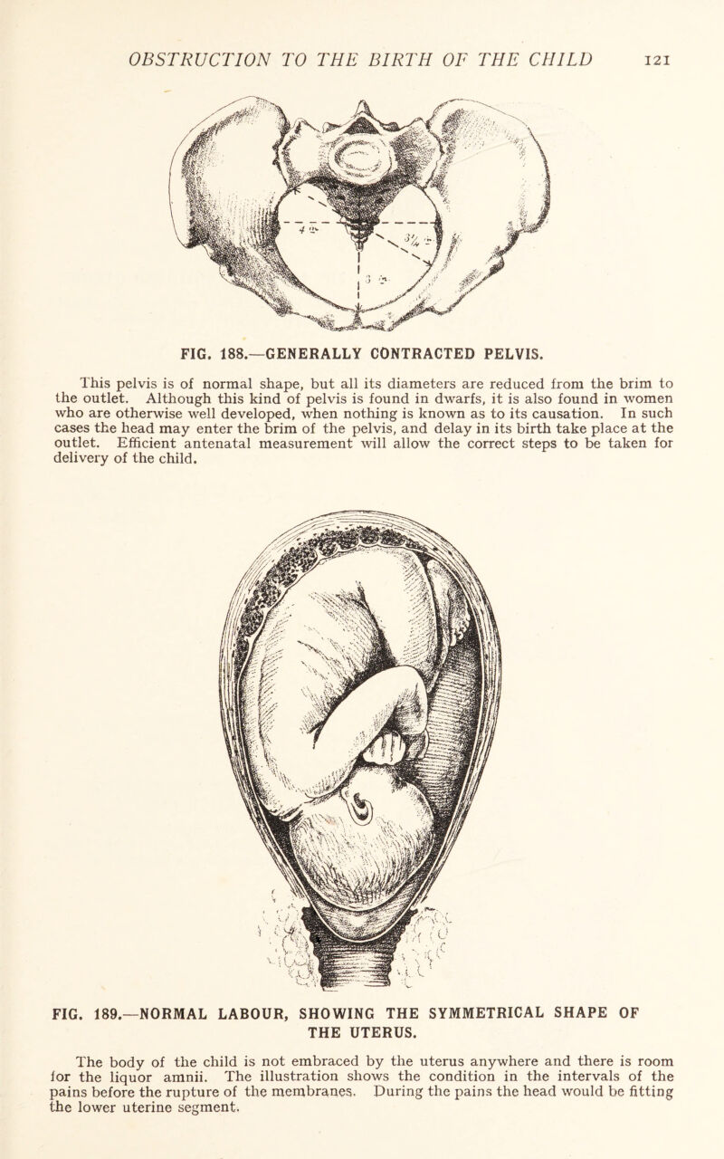 FIG. 188.—GENERALLY CONTRACTED PELVIS. This pelvis is of normal shape, but all its diameters are reduced from the brim to the outlet. Although this kind of pelvis is found in dwarfs, it is also found in women who are otherwise well developed, when nothing is known as to its causation. In such cases the head may enter the brim of the pelvis, and delay in its birth take place at the outlet. Efficient antenatal measurement will allow the correct steps to be taken for delivery of the child. FIG. 189.—NORMAL LABOUR, SHOWING THE SYMMETRICAL SHAPE OF THE UTERUS. The body of the child is not embraced by the uterus anywhere and there is room lor the liquor amnii. The illustration shows the condition in the intervals of the pains before the rupture of the membranes. During the pains the head would be fitting the lower uterine segment.