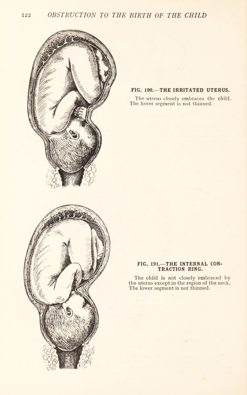 FIG. 190—THE IRRITATED UTERUS. The uterus closely embraces the child. The lower segment is not thinned. FIG. 191.—THE INTERNAL CON¬ TRACTION RING. The child is not closely embraced by the uterus except in the region of the neck. The lower segment is not thinned.