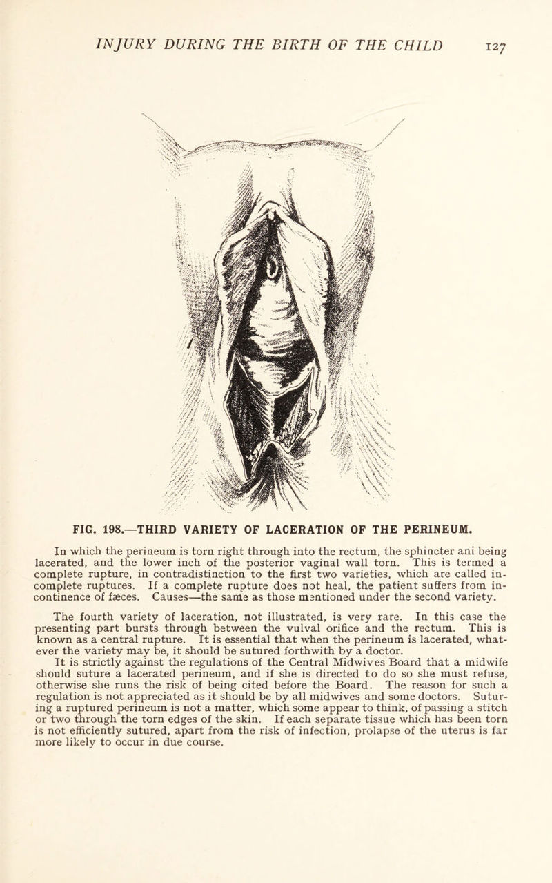 FIG. 198.—THIRD VARIETY OF LACERATION OF THE PERINEUM. Ia which the perineum is torn right through into the rectum, the sphincter ani being lacerated, and the lower inch of the posterior vaginal wall torn. This is termed a complete rupture, in contradistinction to the first two varieties, which are called in- complete ruptures. If a complete rupture does not heal, the patient suffers from in¬ continence of faeces. Causes—the same as those mentioned under the second variety. The fourth variety of laceration, not illustrated, is very rare. In this case the presenting part bursts through between the vulval orifice and the rectum. This is known as a central rupture. It is essential that when the perineum is lacerated, what¬ ever the variety may be, it should be sutured forthwith by a doctor. It is strictly against the regulations of the Central Midwives Board that a midwife should suture a lacerated perineum, and if she is directed to do so she must refuse, otherwise she runs the risk of being cited before the Board. The reason for such a regulation is not appreciated as it should be by all midwives and some doctors. Sutur¬ ing a ruptured perineum is not a matter, which some appear to think, of passing a stitch or two through the torn edges of the skin. If each separate tissue which has been torn is not efficiently sutured, apart from the risk of infection, prolapse of the uterus is far more likely to occur in due course.