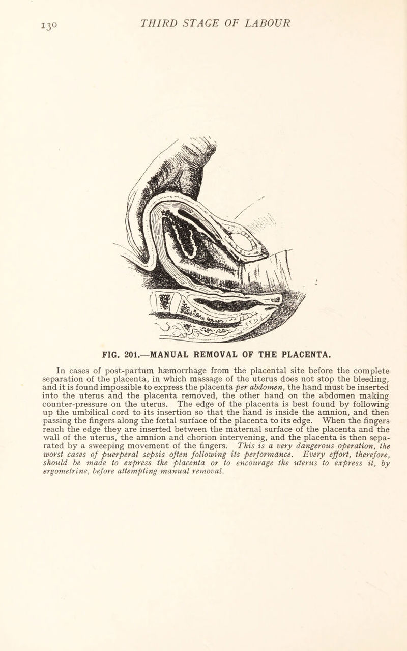 i3° FIG. 201.—MANUAL REMOVAL OF THE PLACENTA. In cases of post-partum haemorrhage from the placental site before the complete separation of the placenta, in which massage of the uterus does not stop the bleeding, and it is found impossible to express the placenta per abdomen, the hand must be inserted into the uterus and the placenta removed, the other hand on the abdomen making counter-pressure on the uterus. The edge of the placenta is best found by following up the umbilical cord to its insertion so that the hand is inside the amnion, and then passing the fingers along the foetal surface of the placenta to its edge. When the fingers reach the edge they are inserted between the maternal surface of the placenta and the wall of the uterus, the amnion and chorion intervening, and the placenta is then sepa¬ rated by a sweeping movement of the fingers. This is a very dangerous operation, the ivorst cases of puerperal sepsis often following its performance. Every effort, therefore, should be made to express the placenta or to encourage the uterus to express it, by ergometrine, before attempting manual removal.