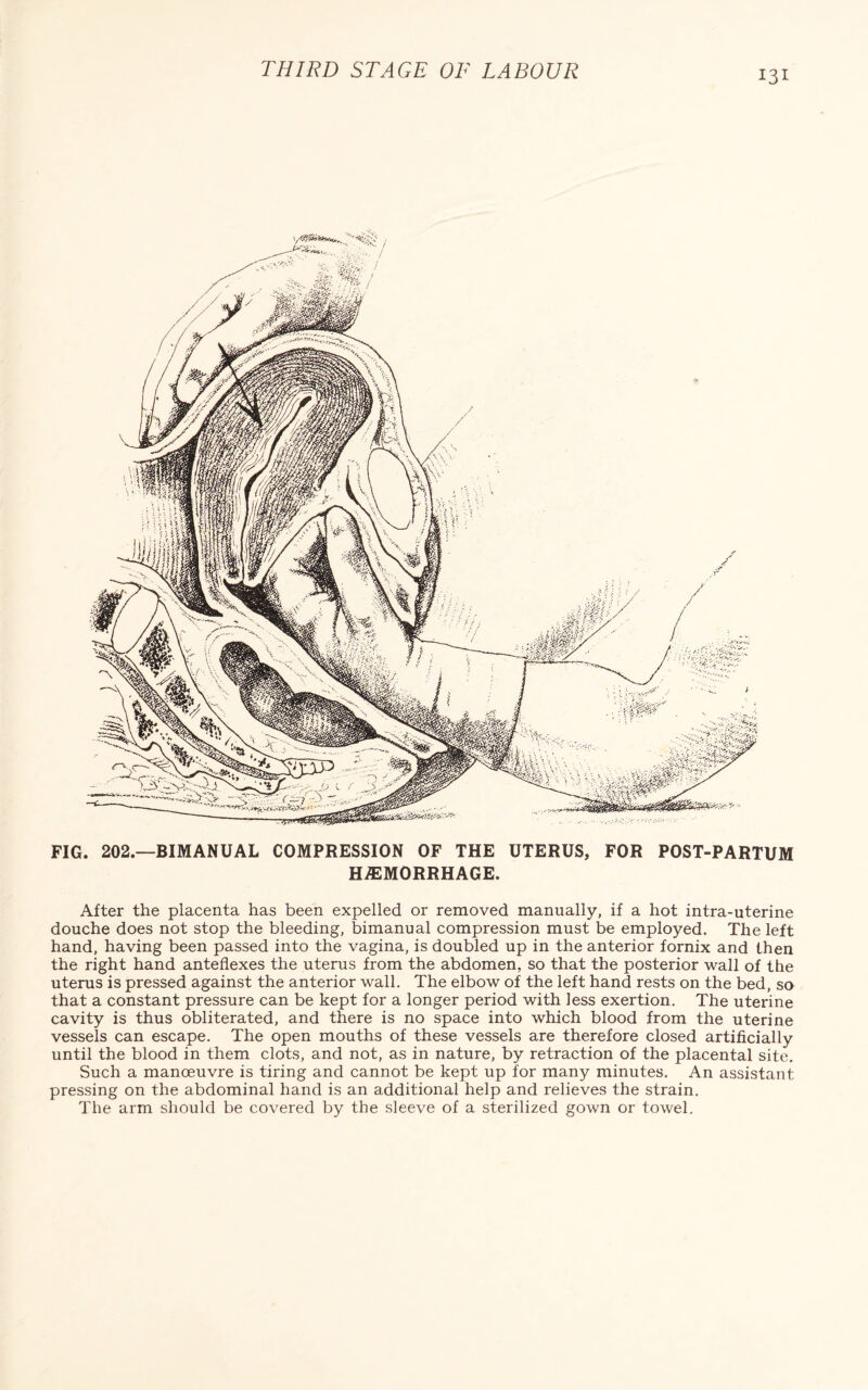 FIG. 202.—BIMANUAL COMPRESSION OF THE UTERUS, FOR POST-PARTUM HAEMORRHAGE. After the placenta has been expelled or removed manually, if a hot intra-uterine douche does not stop the bleeding, bimanual compression must be employed. The left hand, having been passed into the vagina, is doubled up in the anterior fornix and then the right hand anteflexes the uterus from the abdomen, so that the posterior wall of the uterus is pressed against the anterior wall. The elbow of the left hand rests on the bed, so that a constant pressure can be kept for a longer period with less exertion. The uterine cavity is thus obliterated, and there is no space into which blood from the uterine vessels can escape. The open mouths of these vessels are therefore closed artificially until the blood in them clots, and not, as in nature, by retraction of the placental site. Such a manoeuvre is tiring and cannot be kept up for many minutes. An assistant pressing on the abdominal hand is an additional help and relieves the strain. The arm should be covered by the sleeve of a sterilized gown or towel.